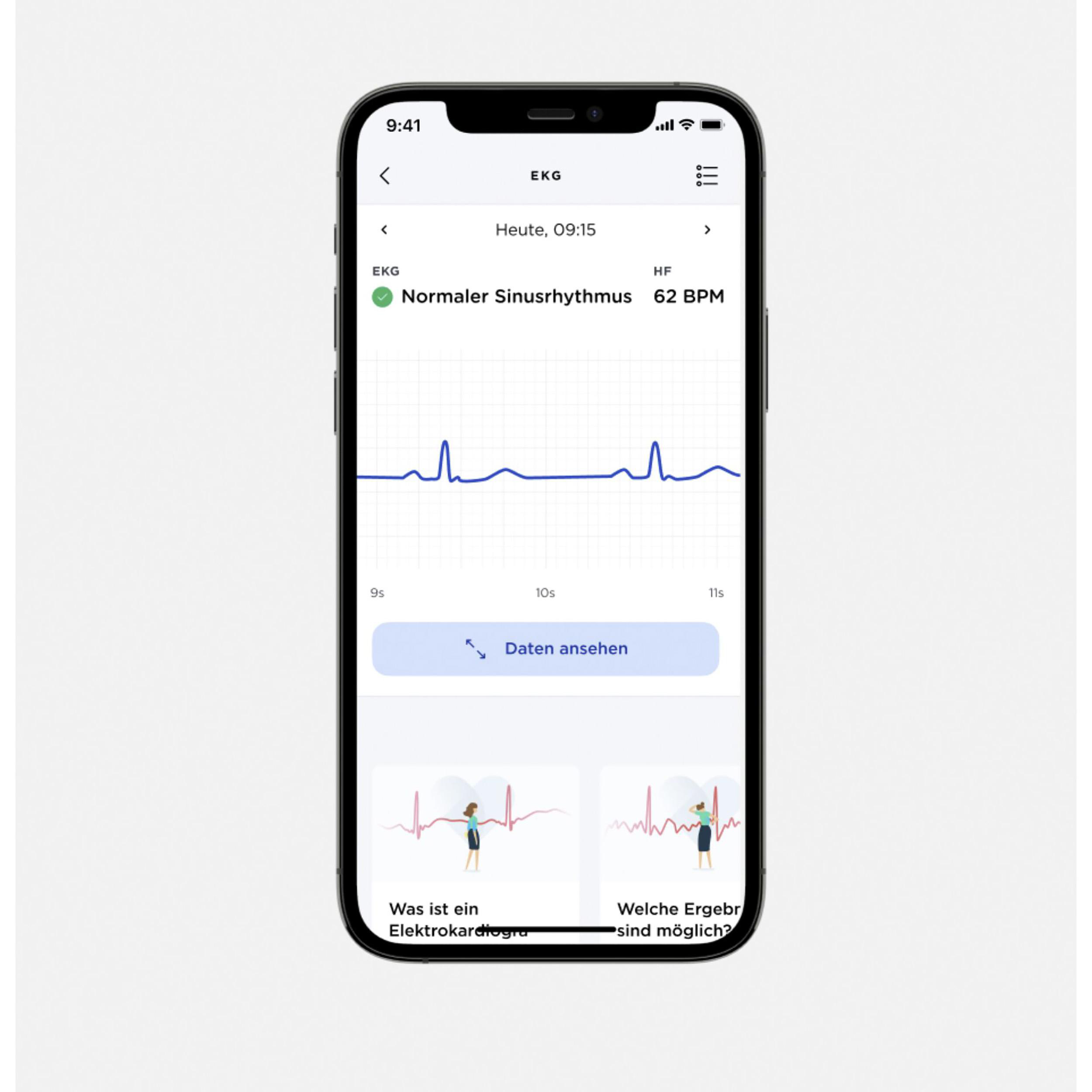 Smartphone mit EKG-Diagramm, das einen normalen Sinusrhythmus und 62 BPM anzeigt.