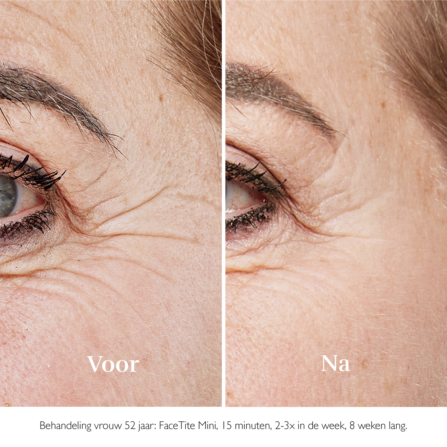 Close-up van het gezicht van een vrouw, vergelijking van rimpels voor en na een behandeling.