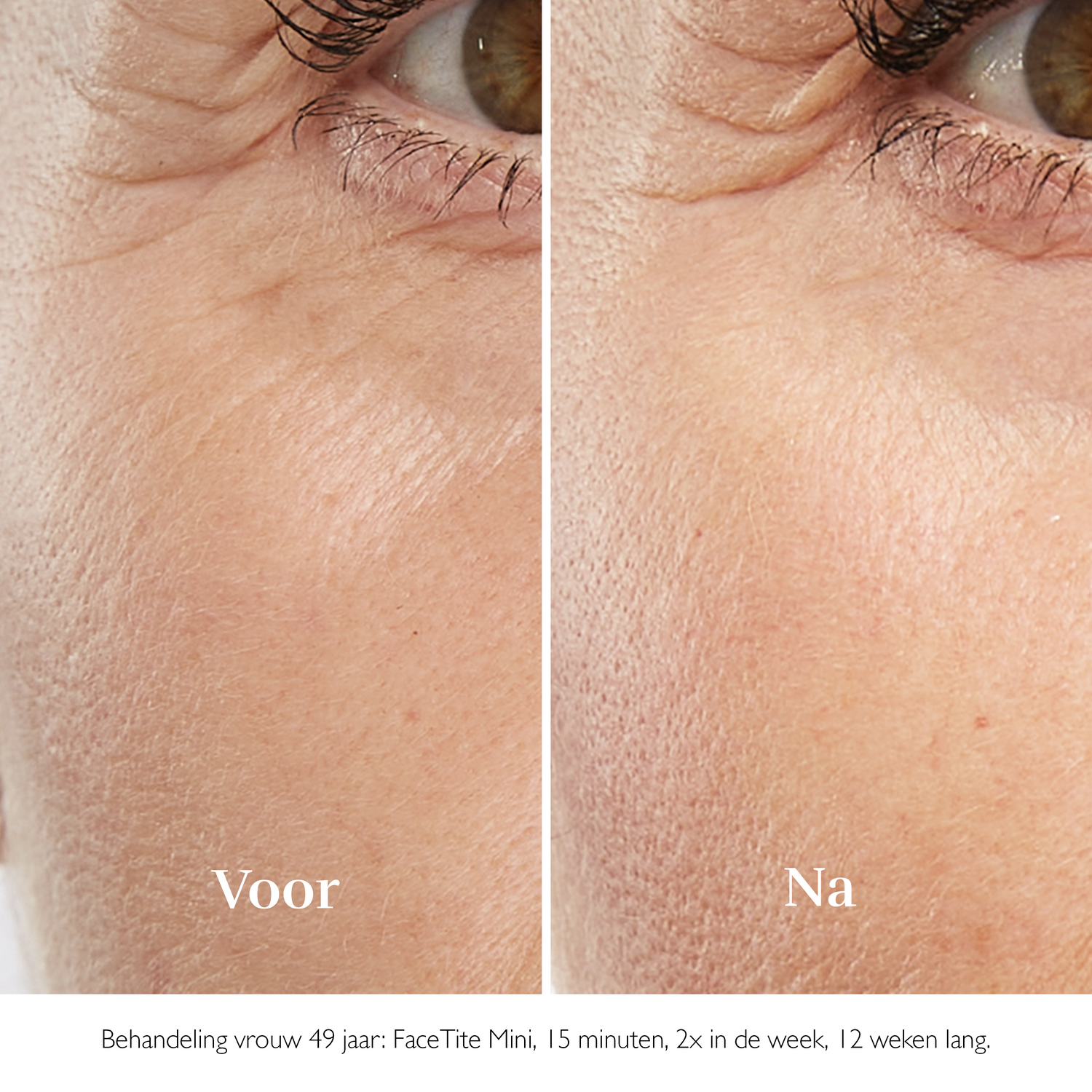 Close-up van het gezicht van een vrouw die de voor- en na resultaten van een huidbehandeling laat zien.