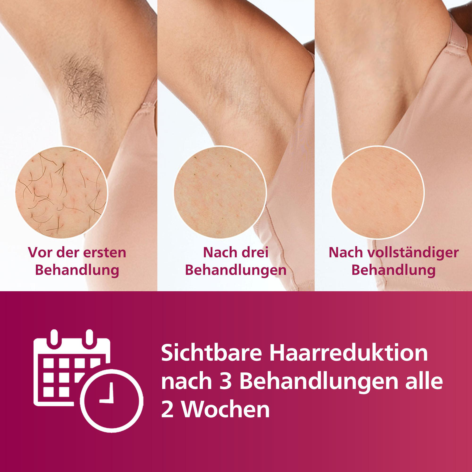 Bild zeigt Haarreduktionsstadien nach Behandlungen. Achseln mit Haaren, nach 3 Behandlungen und nach vollständiger Behandlung.