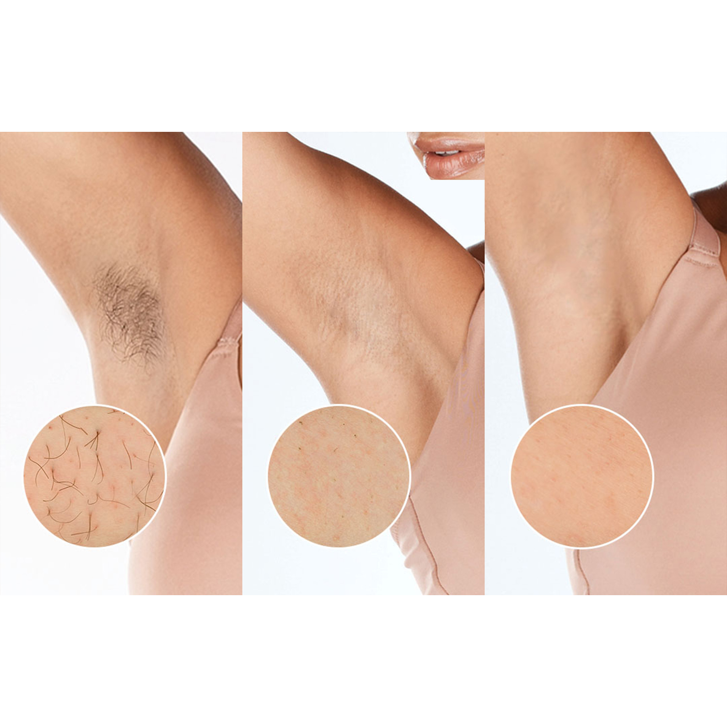Three stages of underarm hair removal, with close-up details.