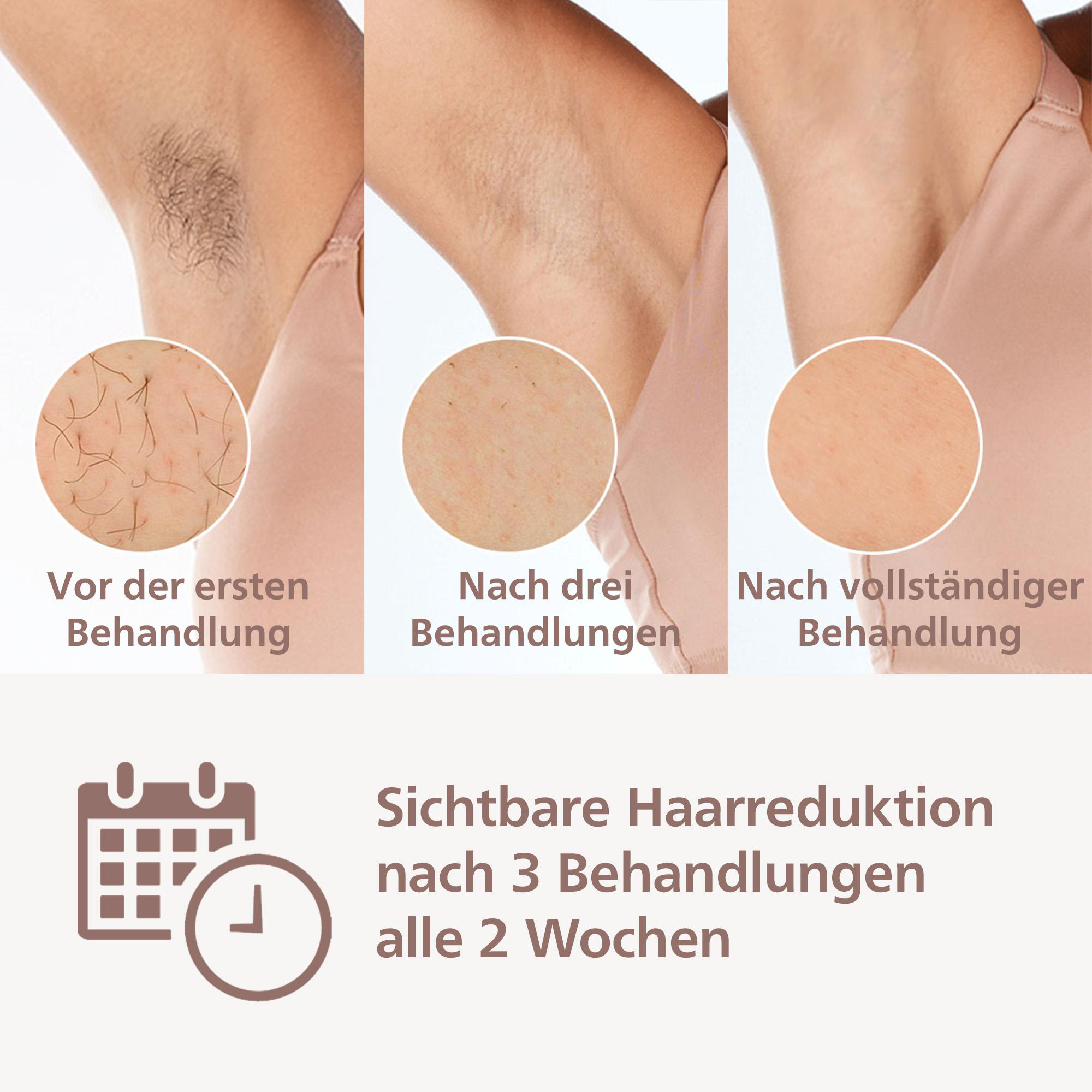 Drei Bilder zeigen die Haarreduktion nach Behandlungen. Kalender- und Uhrensymbole sind vorhanden.