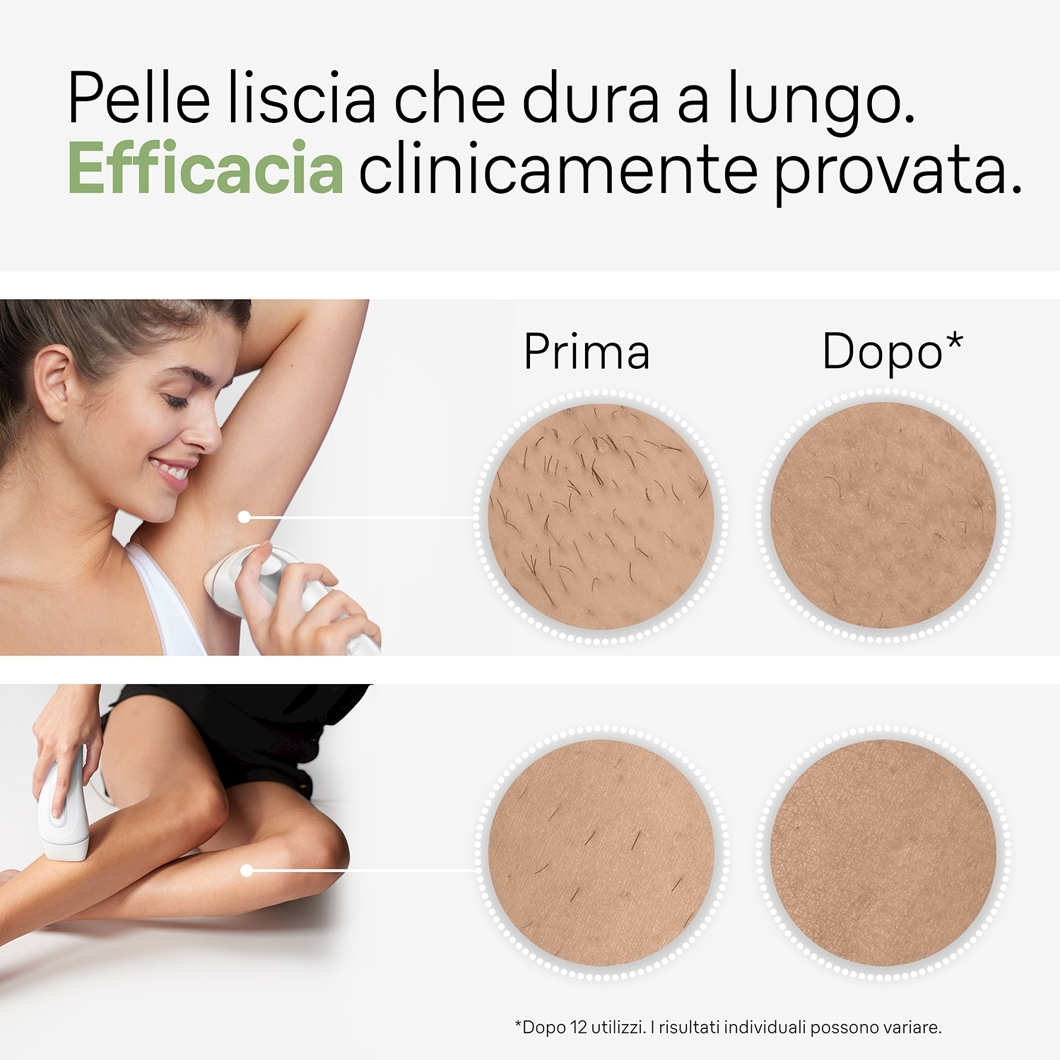 Immagini prima e dopo la depilazione con un dispositivo di depilazione.