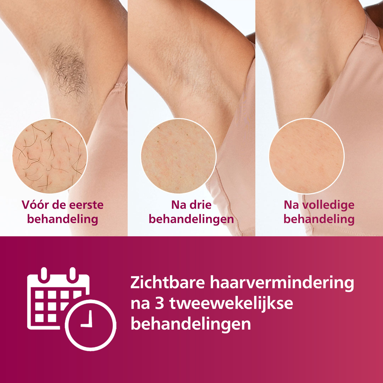 Drie foto's tonen de voortgang van ontharing. De achtergrond is een oksel van een vrouw met haar.