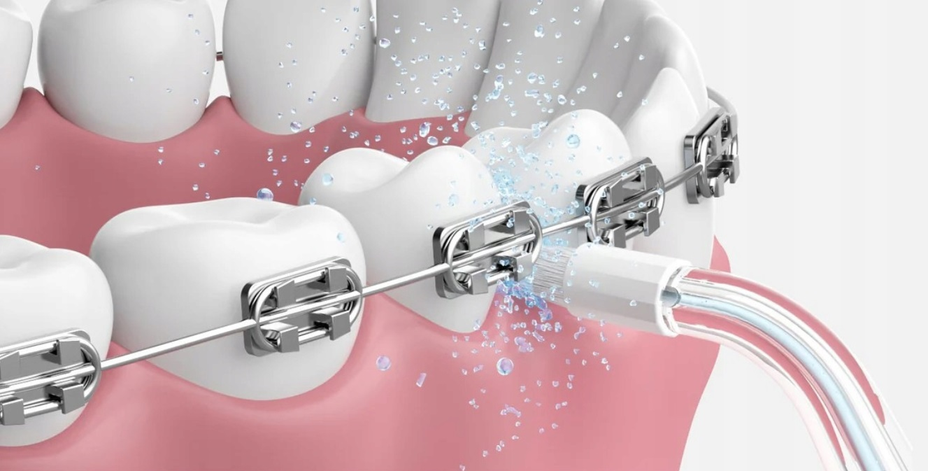 Czyszczenie zębów aparatem ortodontycznym i irygatorem, zbliżenie, ze spryskiwaniem wodą.