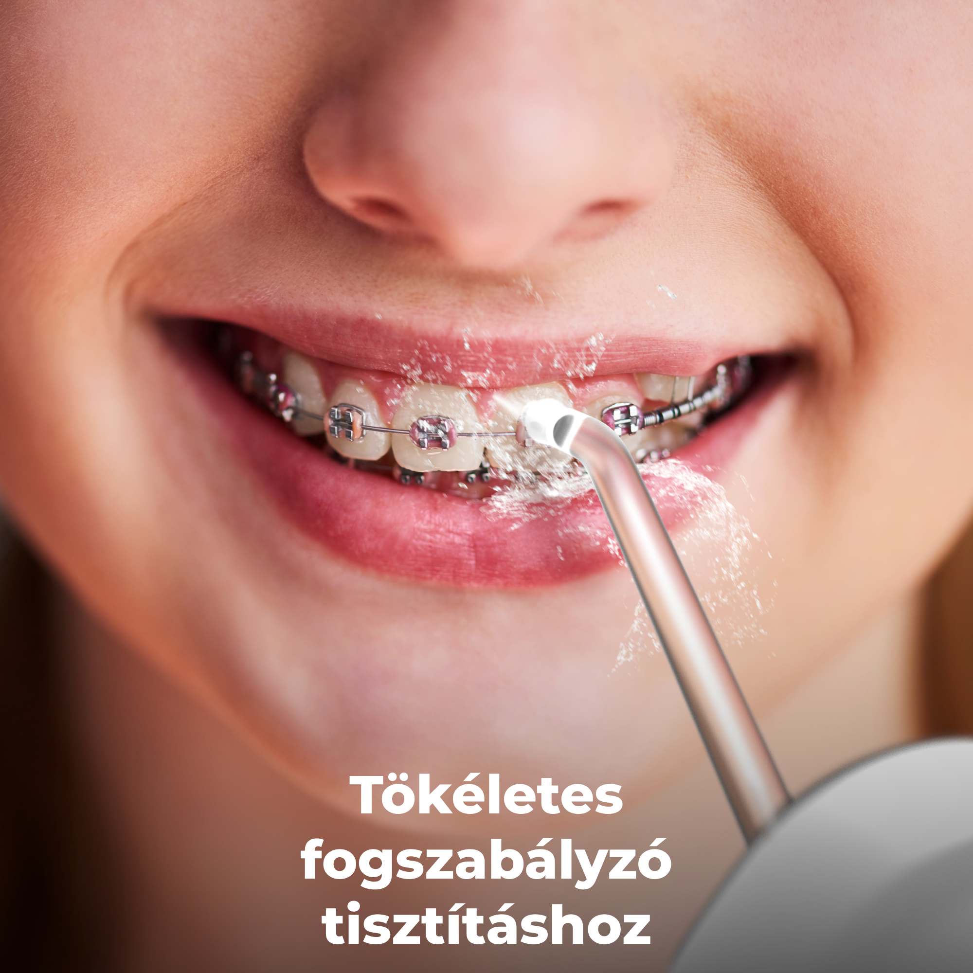 Közelkép a fogszabályzóval rendelkező szájról, amelyet vízzel tisztítanak.