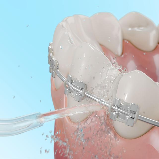 Aparat ortodontyczny, strumień wody czyszczący zęby. Niebieskie tło.