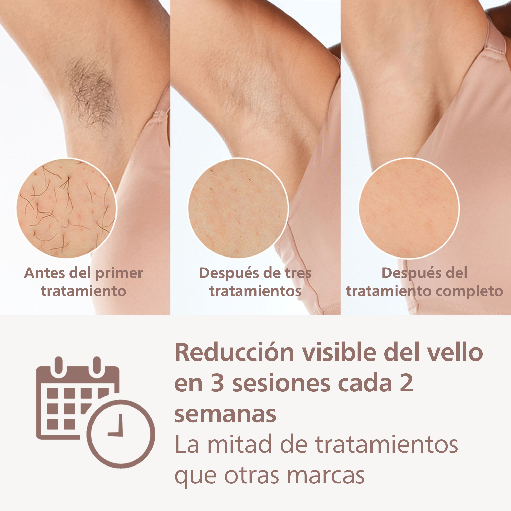 Imágenes muestran reducción de vello en axilas. Antes, después de 3 tratamientos y final.