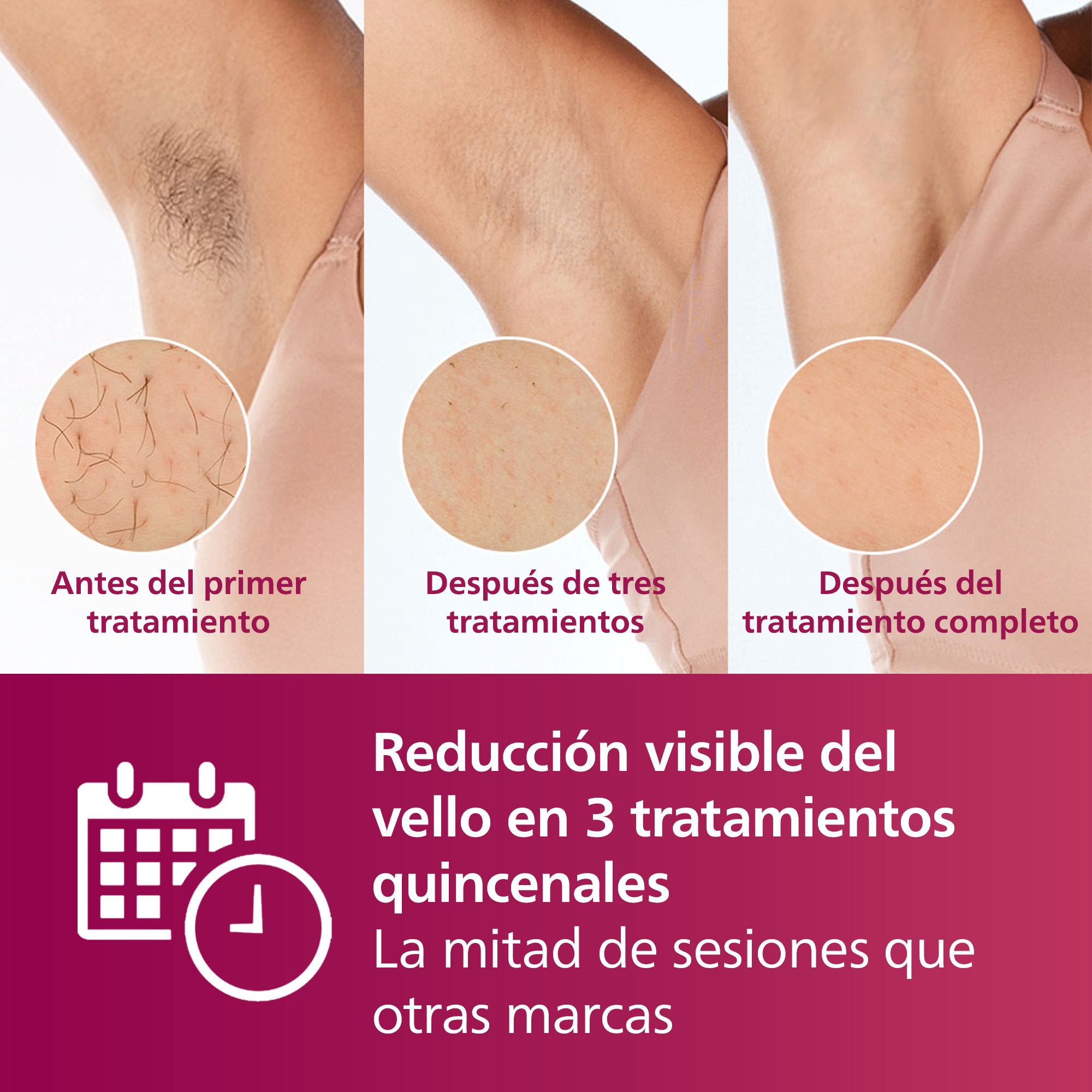 Tres imágenes que muestran los efectos de la depilación en las axilas. El texto explica los resultados.