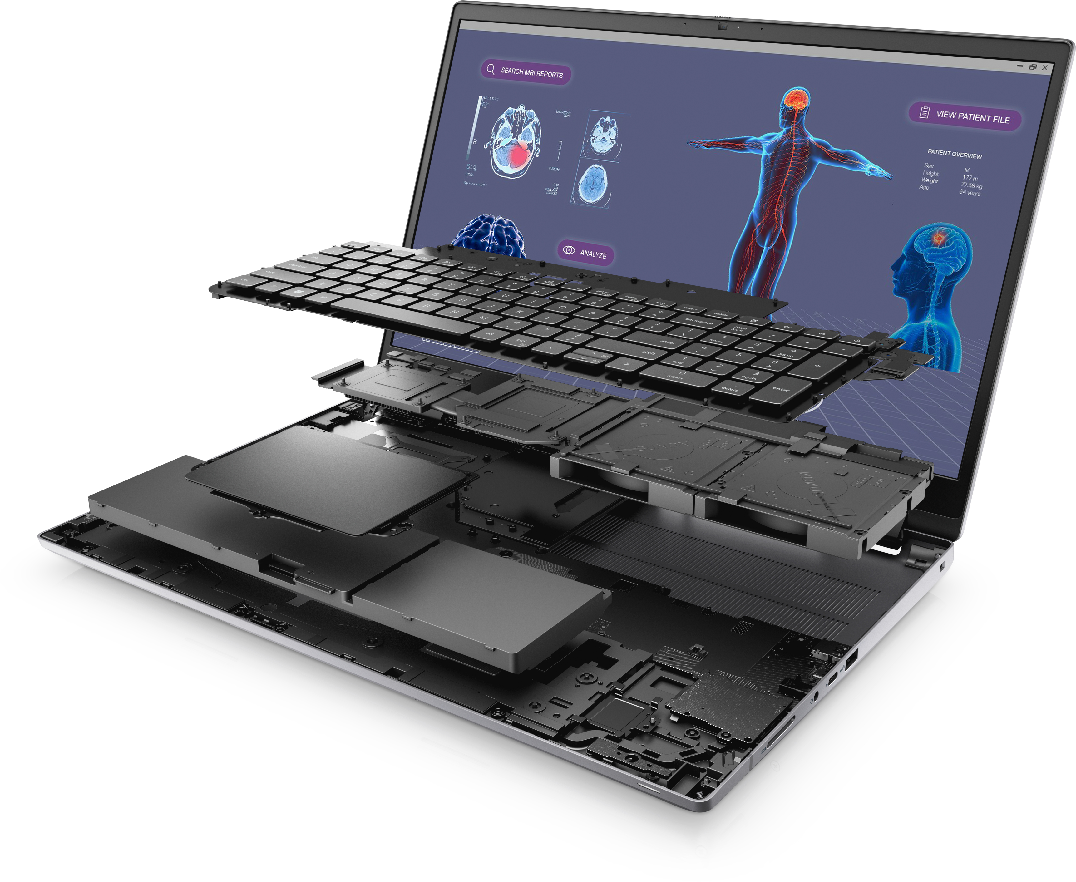 Zerlegter Laptop, zeigt interne Komponenten. Bildschirm zeigt medizinische Scans. Tastatur ist abgenommen.
