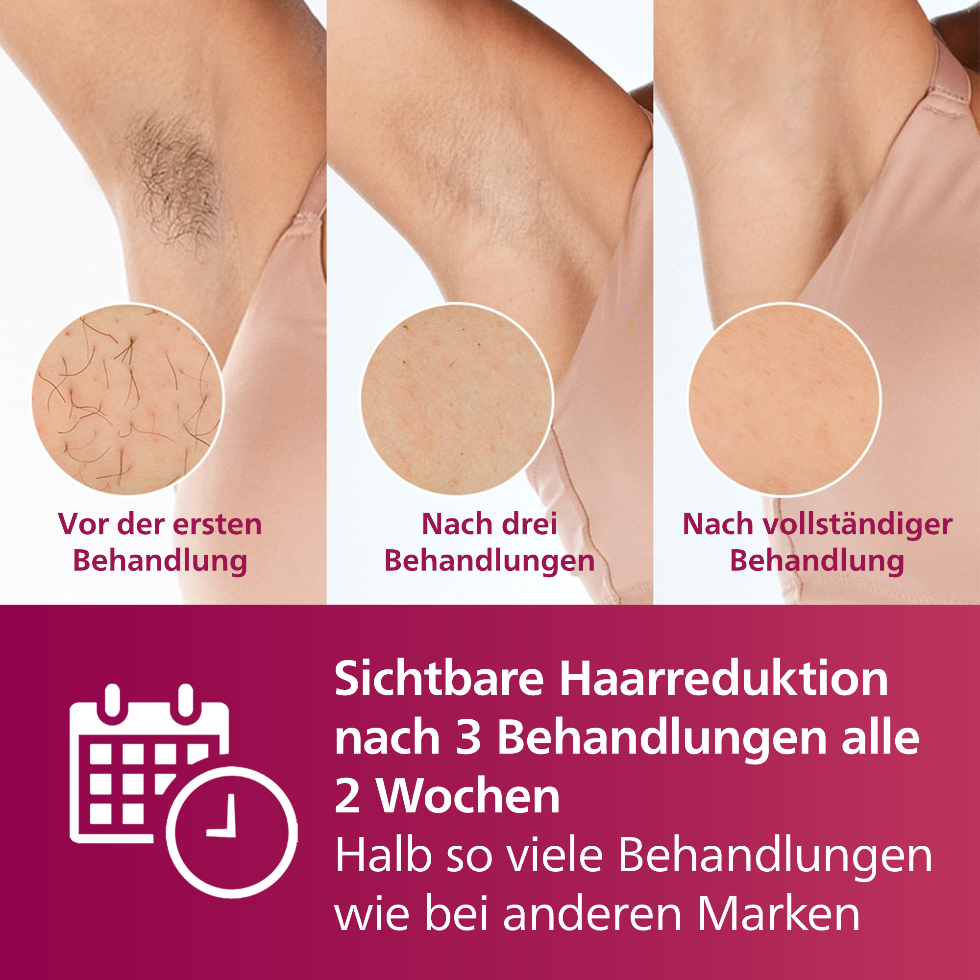 Das Bild zeigt den Fortschritt der Achselhaarentfernung. Es zeigt vorher, nach 3 Behandlungen und nach voller Behandlung. Text: sichtbare Haarreduktion.