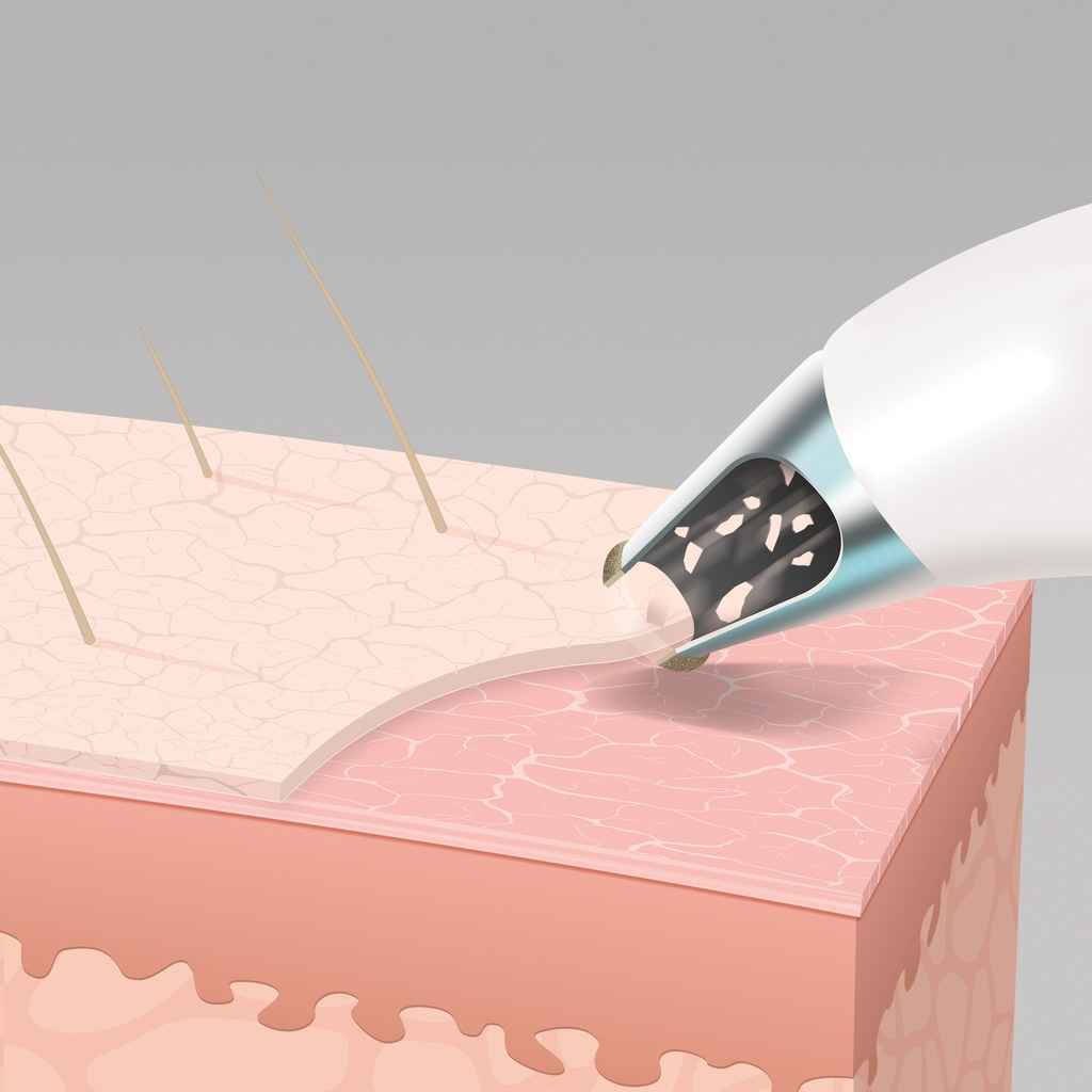 Ilustracja warstw skóry z urządzeniem usuwającym zanieczyszczenia. Na powierzchni skóry widoczne są cienkie włoski, tło jest szare.