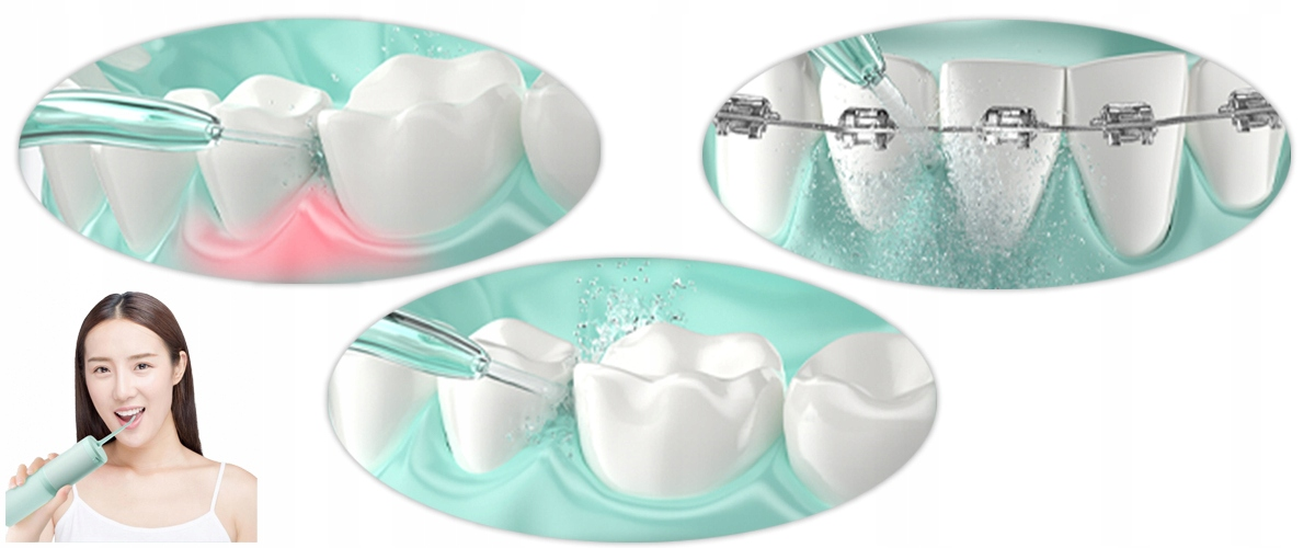 Kobieta trzymająca irygator, zbliżenia pokazują czyszczenie zębów strumieniami wody. Niektóre zęby mają aparat ortodontyczny. Dziąsła wykazują stan zapalny.