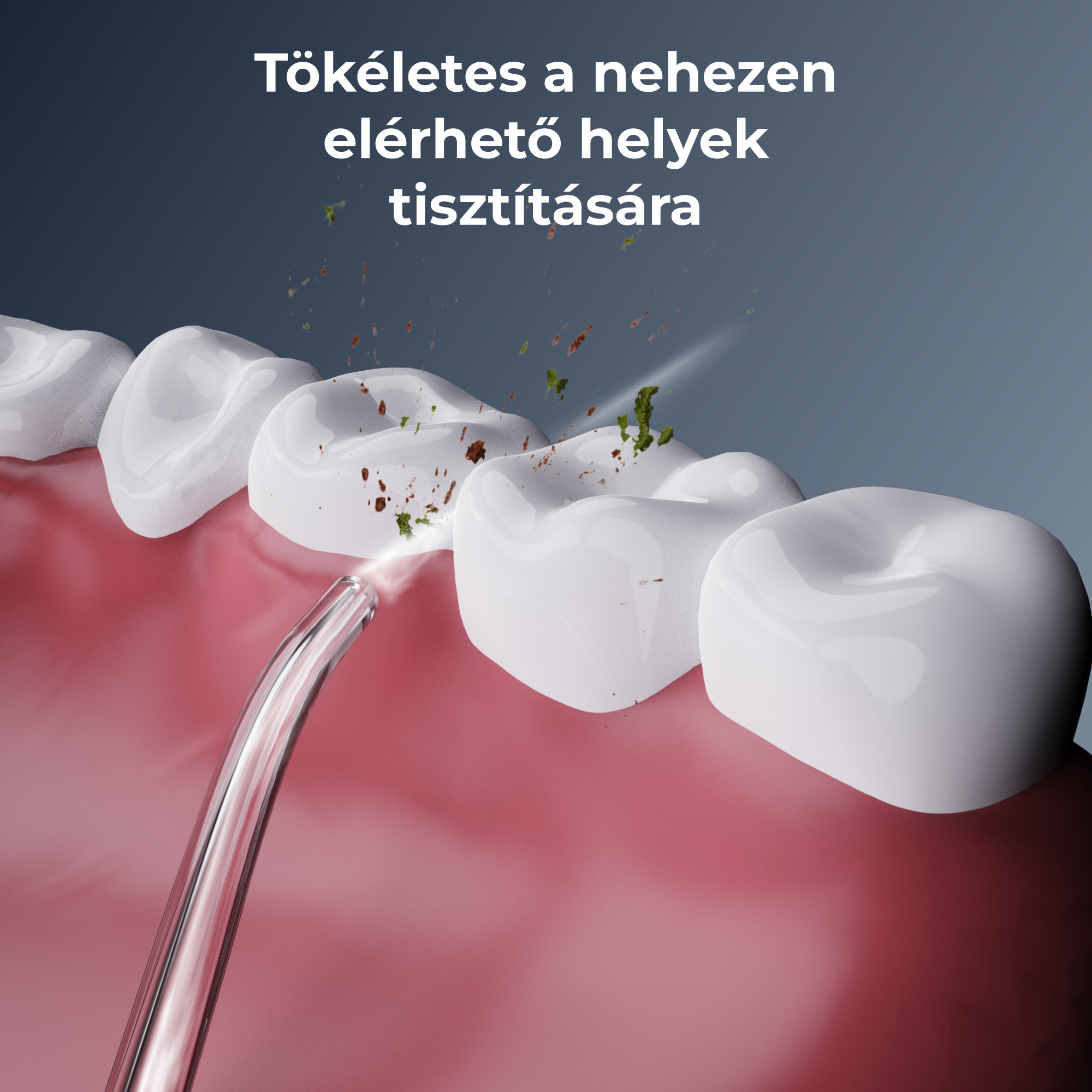 A fogászati higiéniai illusztráció a fogak vízsugárral történő tisztítását mutatja. Barna és zöld törmelék eltávolítása.
