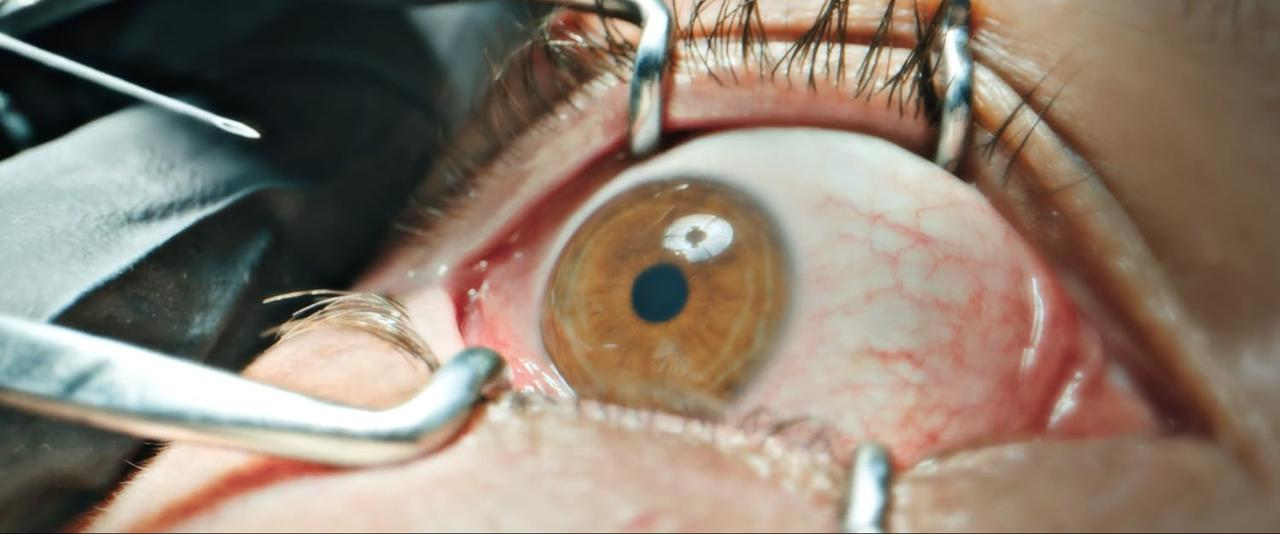 Nahaufnahme eines Auges während eines medizinischen Eingriffs. Die braune Iris ist sichtbar, mit chirurgischen Werkzeugen.