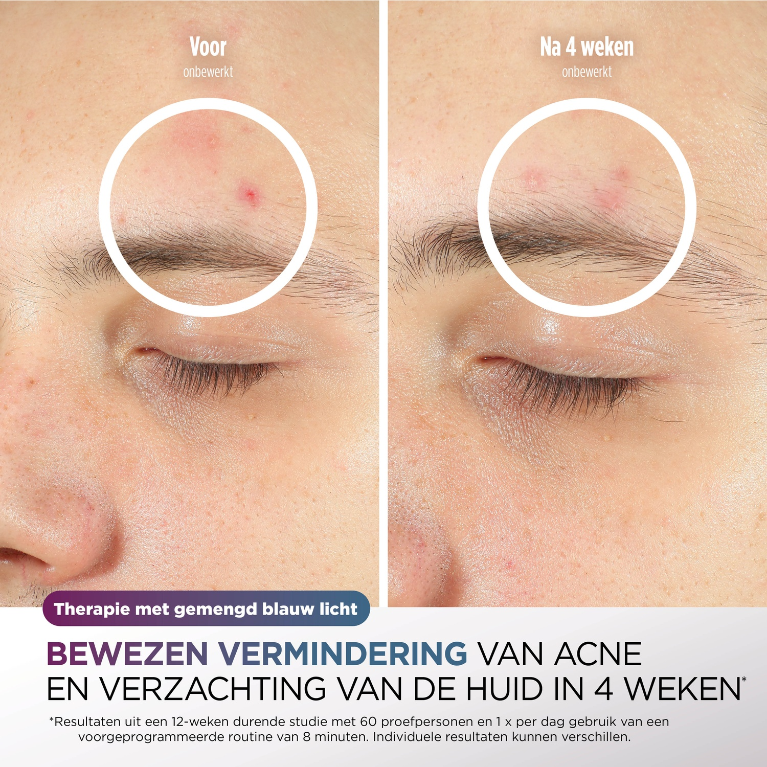 Side-by-side comparison of a person's forehead before and after 4 weeks of treatment, with text about acne reduction.