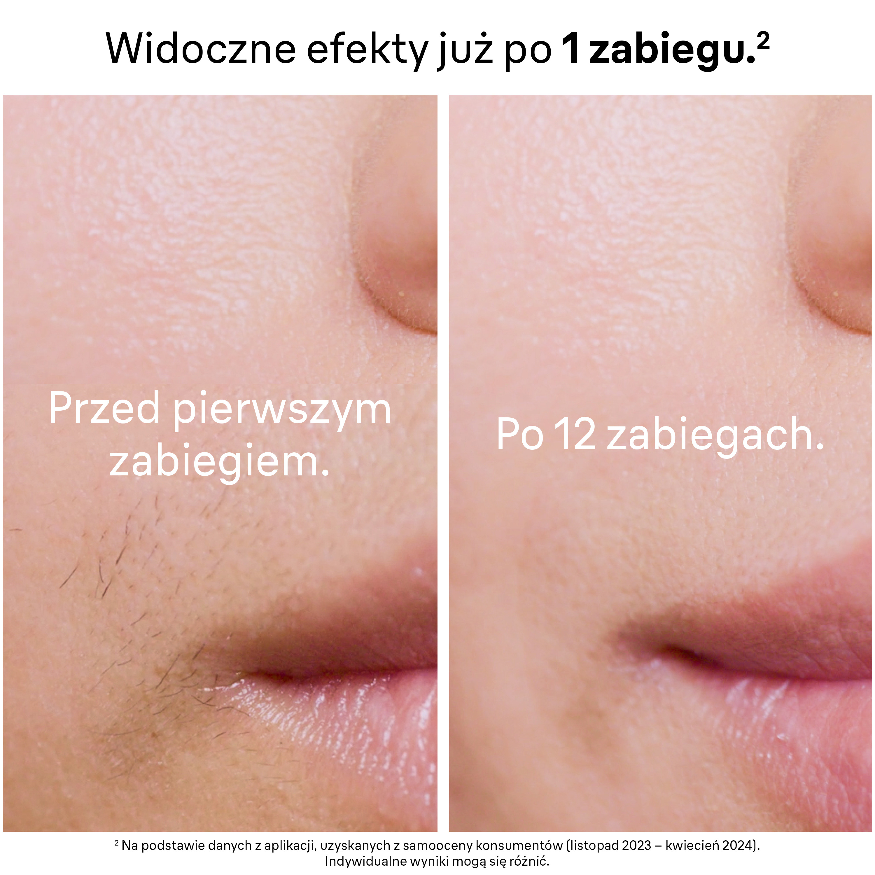 Obraz pokazuje skórę przed i po zabiegu. Przed: owłosiona. Po: gładka. Tekst wskazuje na efekty po jednym zabiegu.