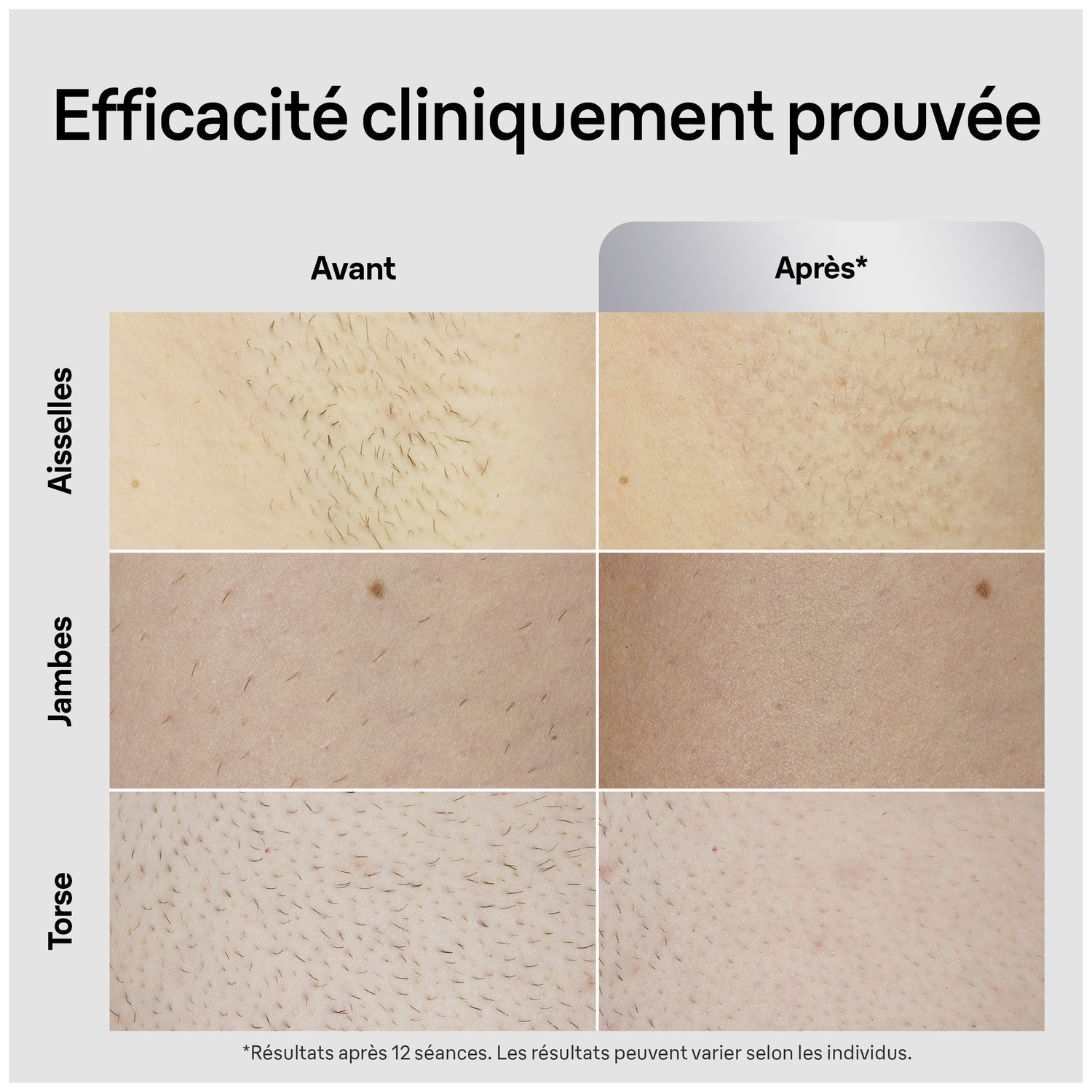 Image montrant les résultats avant/après l'épilation sur aisselles, jambes et torse. Avant : poils, après : peau plus lisse.