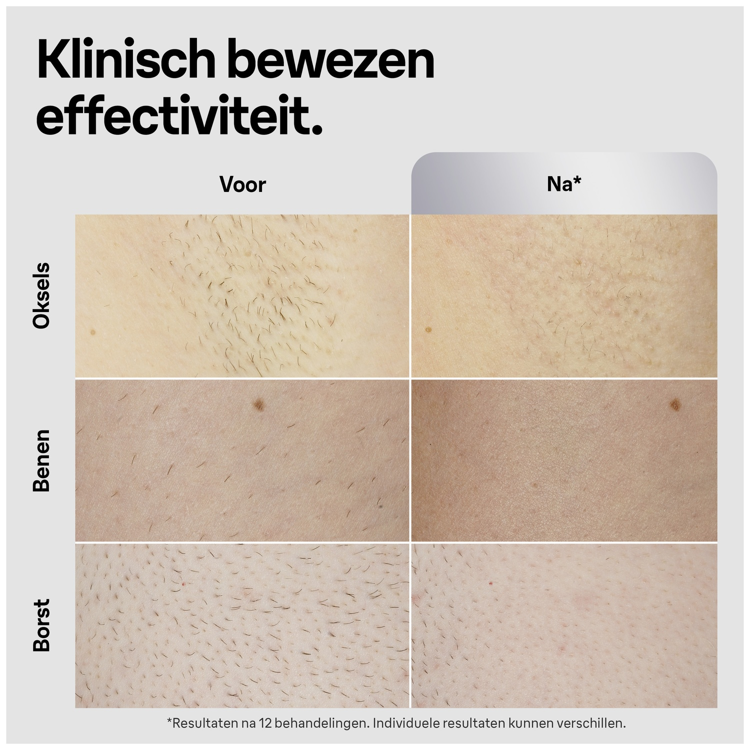 Afbeelding toont resultaten voor en na ontharing. Secties tonen oksels, benen en borst, met haar voor de behandeling en minder daarna.
