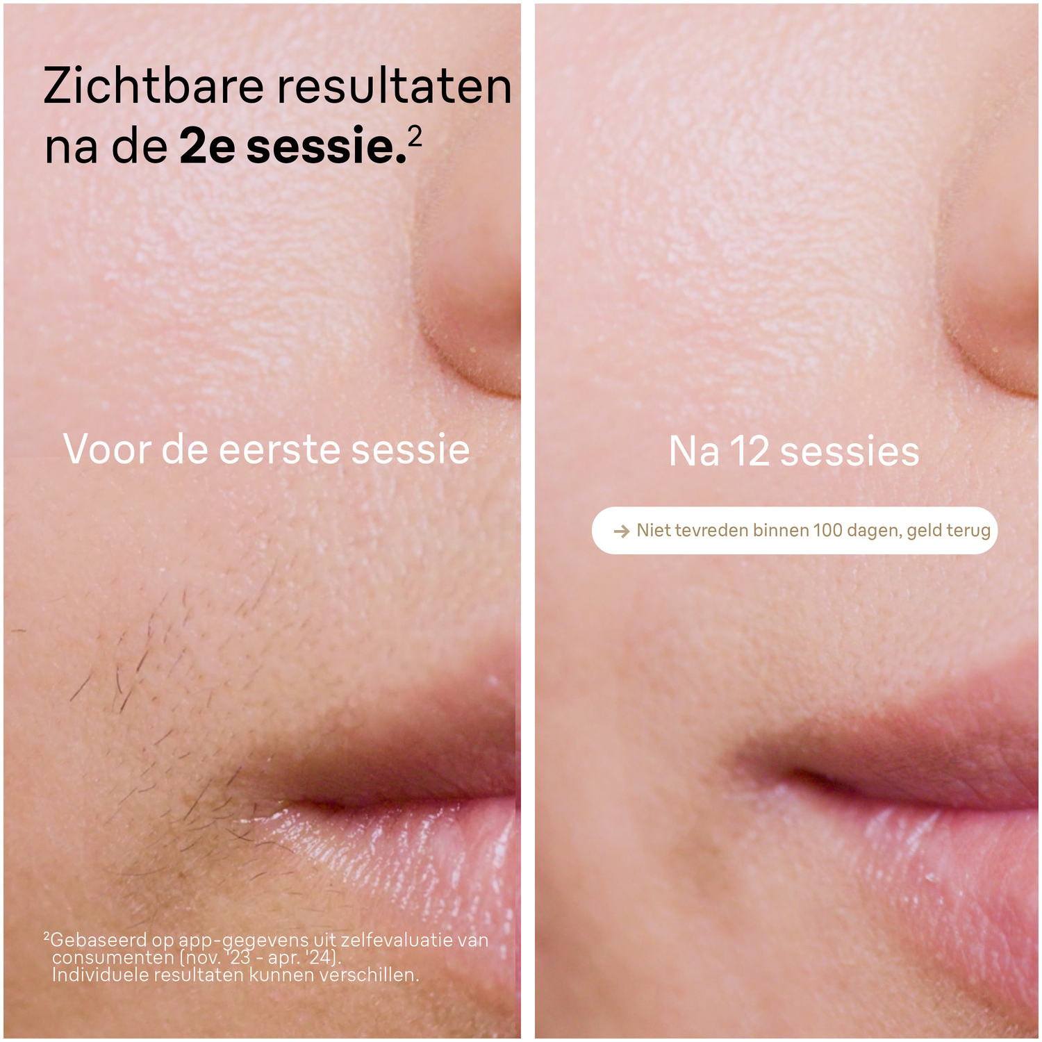 Image shows skin before and after laser hair removal. Before: visible dark hairs. After: smoother skin. Text indicates results after 12 sessions.