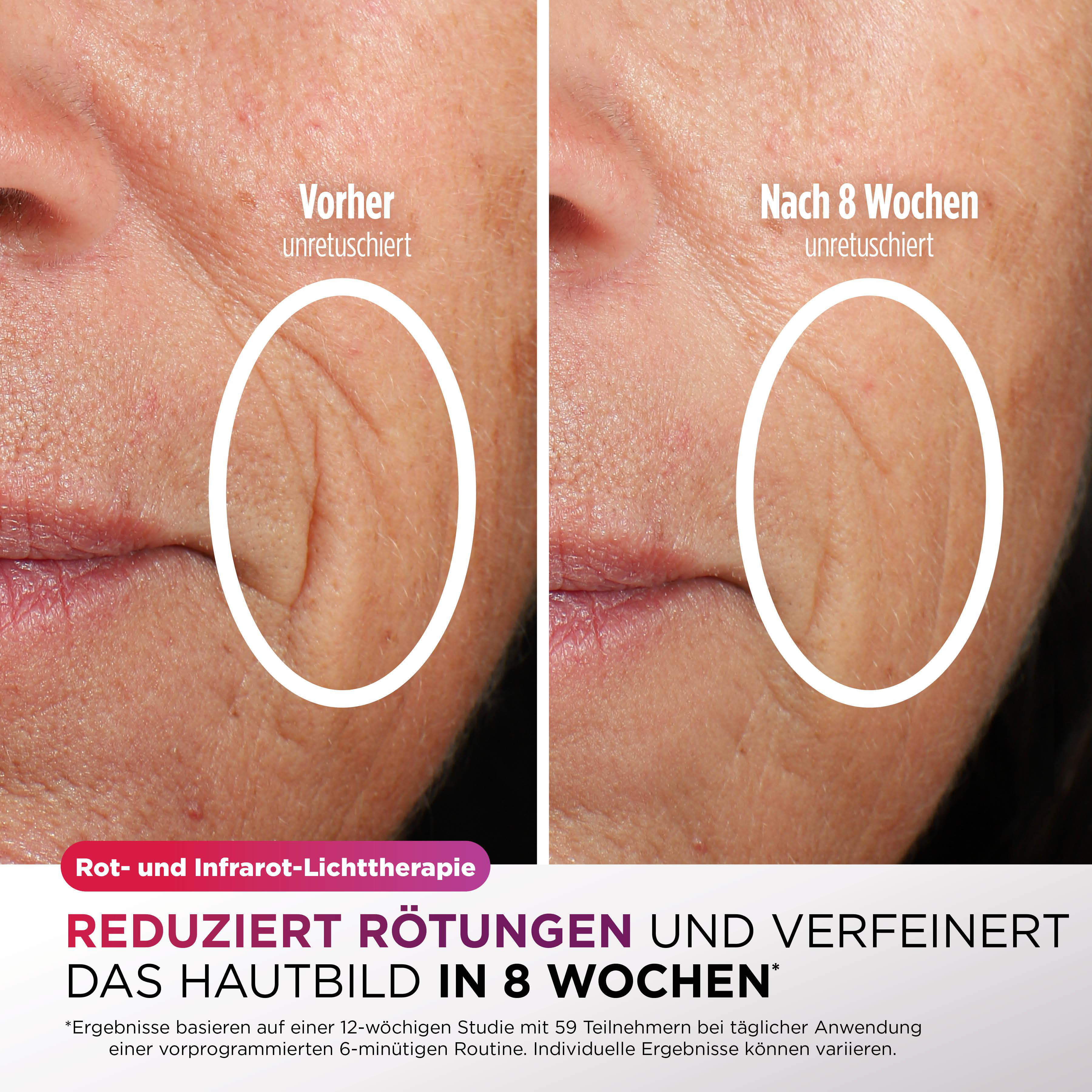 Das Bild zeigt Vorher-Nachher-Hautbehandlung. Falten sind hervorgehoben, Text weist auf weniger Rötungen und verfeinerte Haut hin.