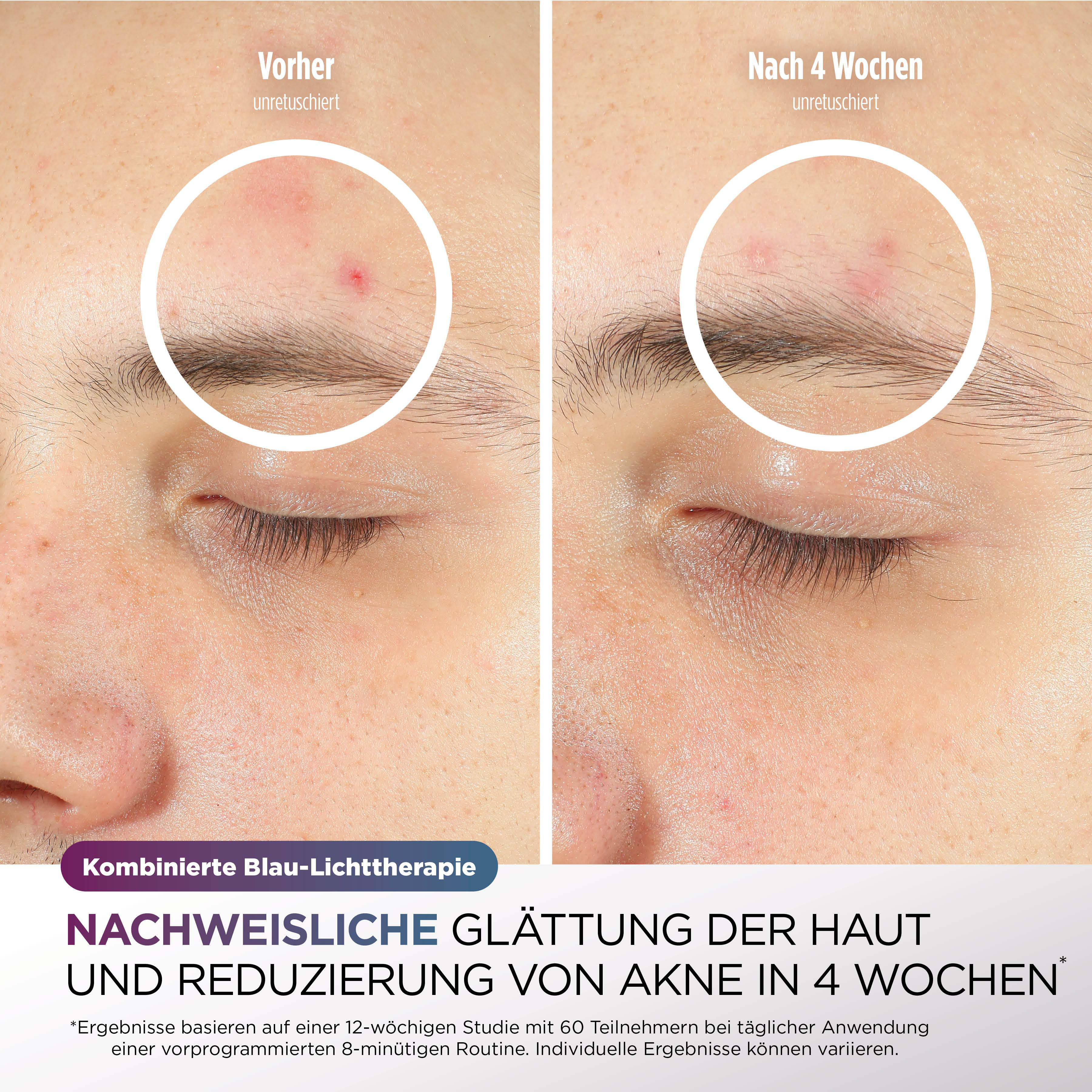 Das Bild zeigt Vorher-Nachher-Hautbehandlung. Die linke Seite zeigt Aknehaut, die rechte Seite verbesserte Haut.