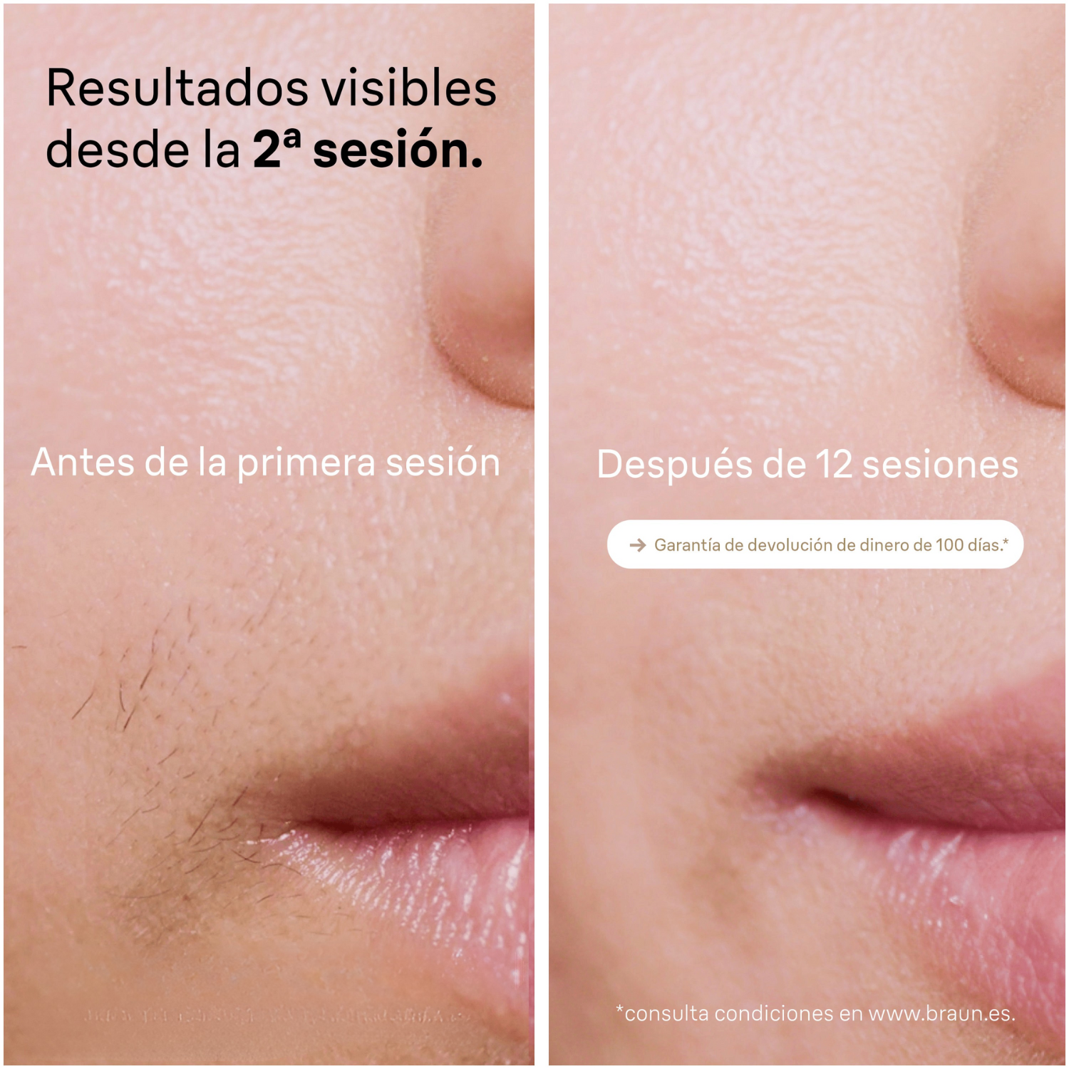 Resultados visibles desde la 2ª sesión. Comparativa antes y después de 12 sesiones. Garantía de devolución durante 100 días. Condiciones en Braun.com