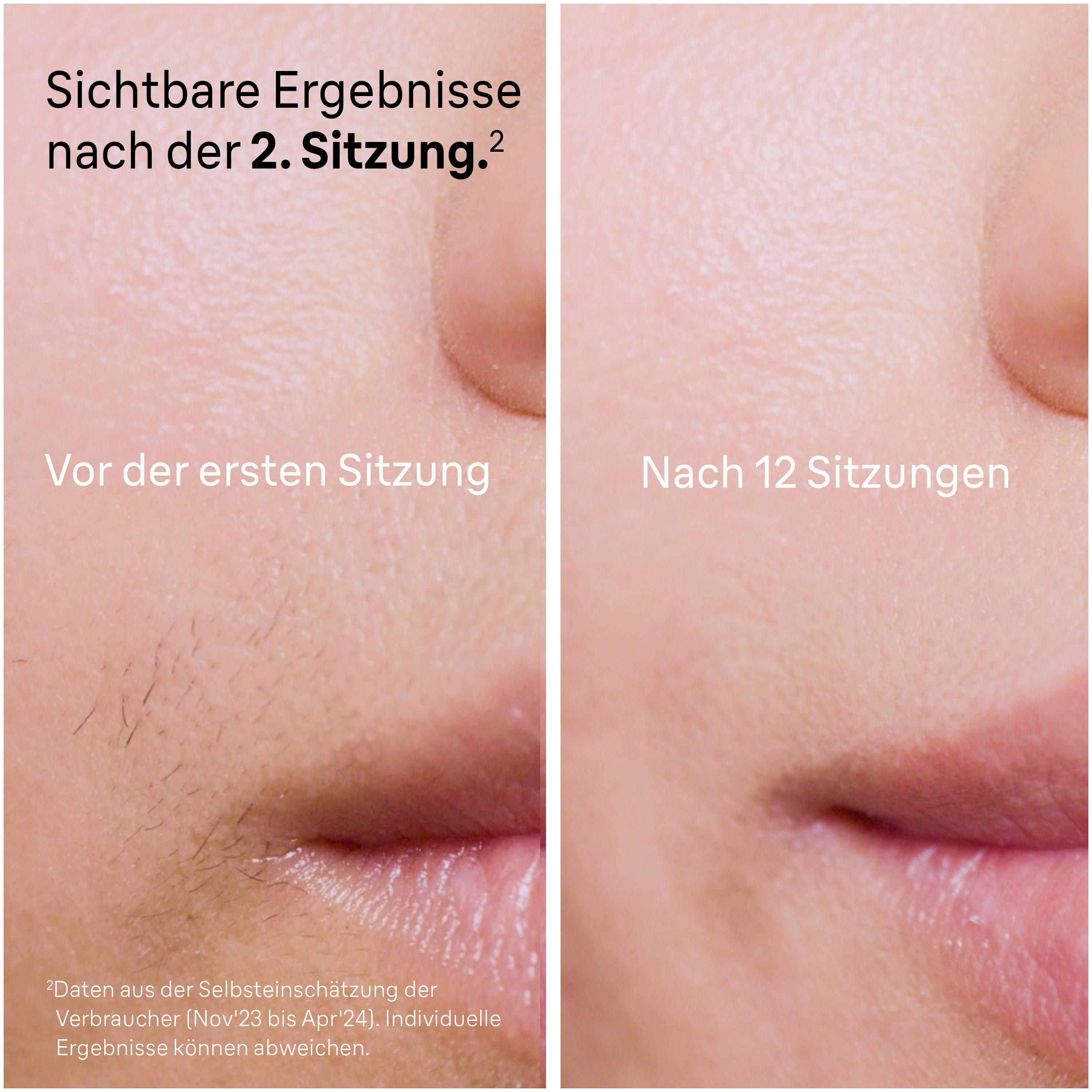 Vorher/Nachher Vergleich von Haut nach Haarentfernungssitzungen.