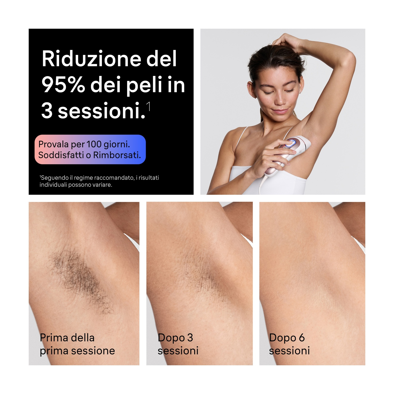Donna usa epilatore IPL; confronto ascella prima e dopo 3 e 6 trattamenti.