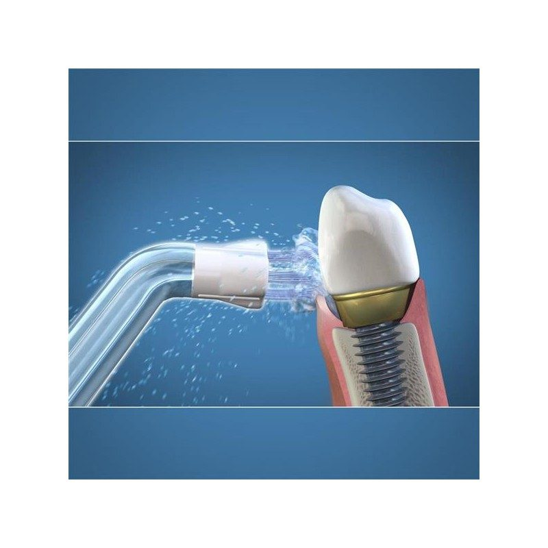 Irygator wodny czyści implant zębowy i obszar dziąseł strumieniem wody.