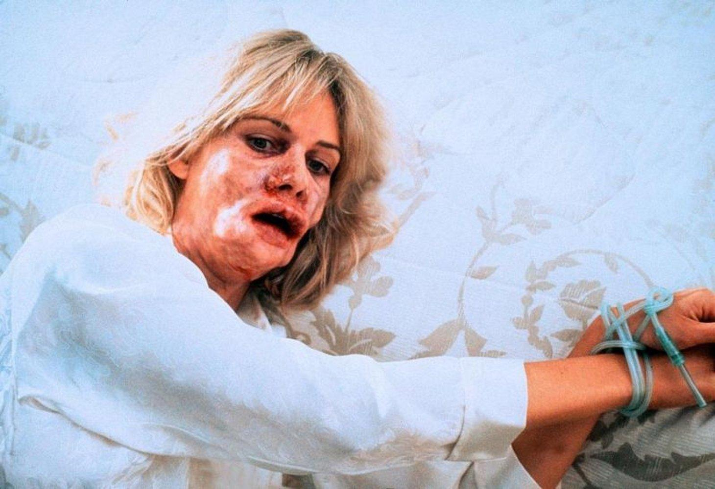 Eine Frau mit verbrennungsähnlichen Verletzungen im Gesicht liegt im Bett.