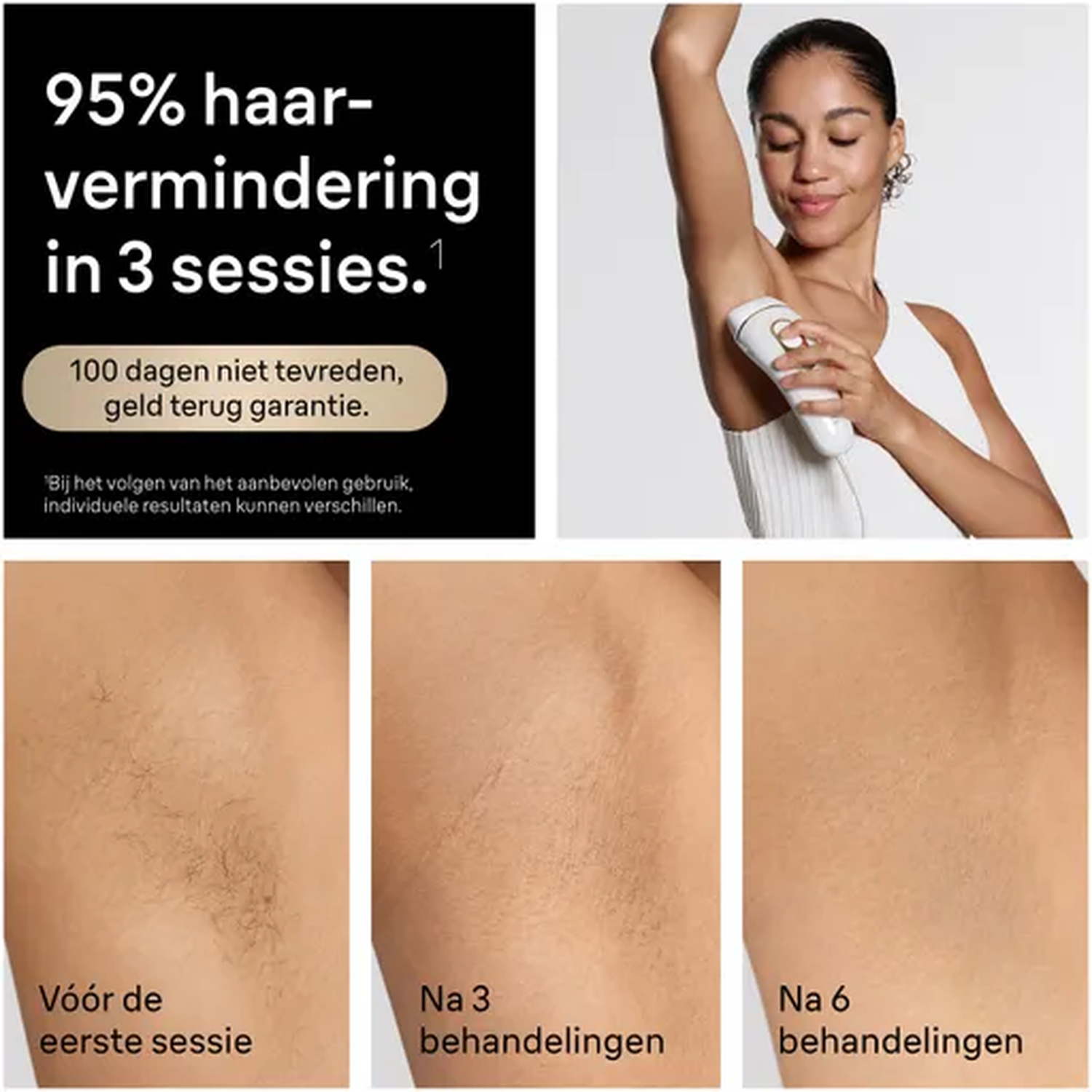 Woman uses IPL device on underarms. Before/after comparison of underarm hair.
