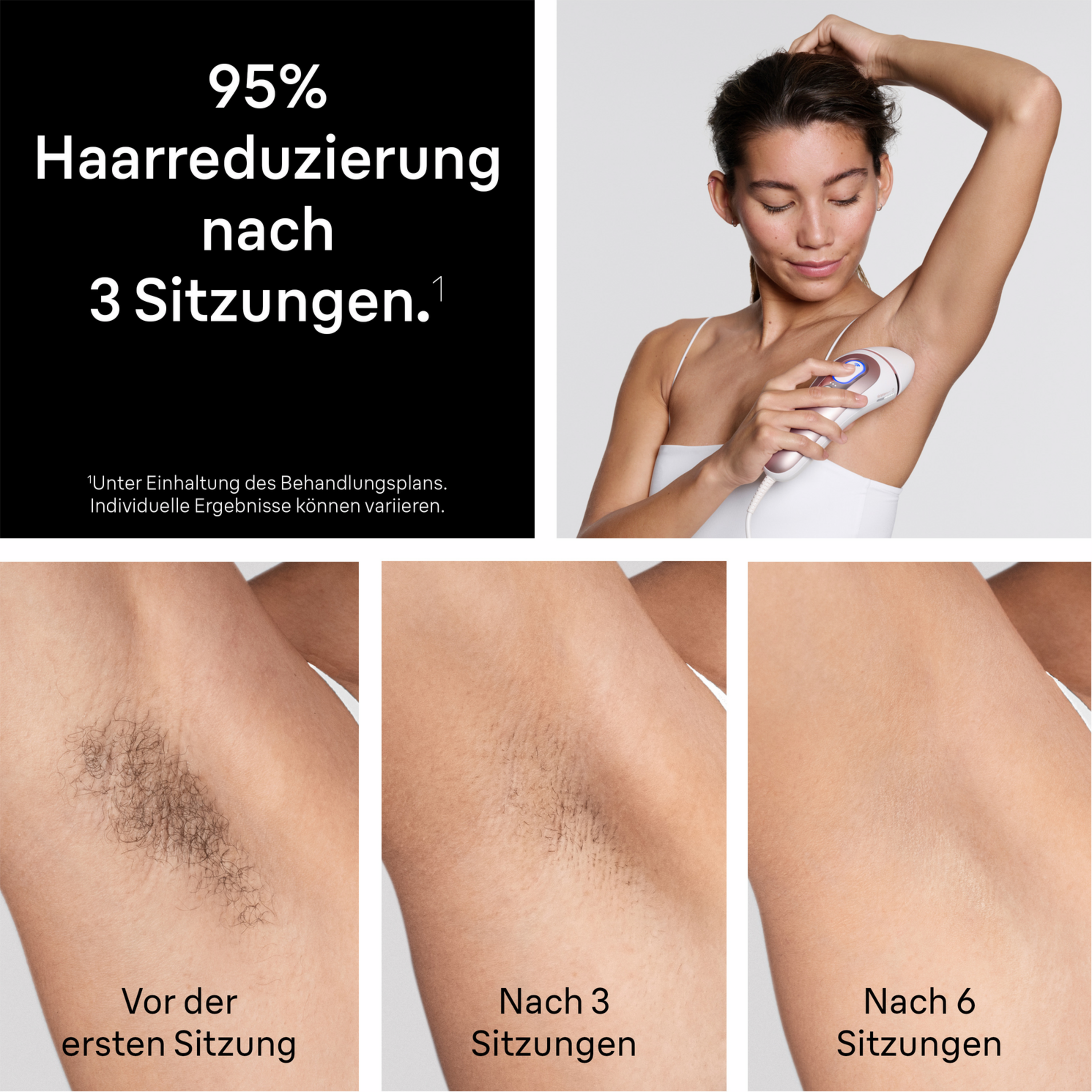 Vorher-Nachher-Bilder zeigen Haarreduktion einer Achselhöhle nach 3 & 6 Behandlungen.