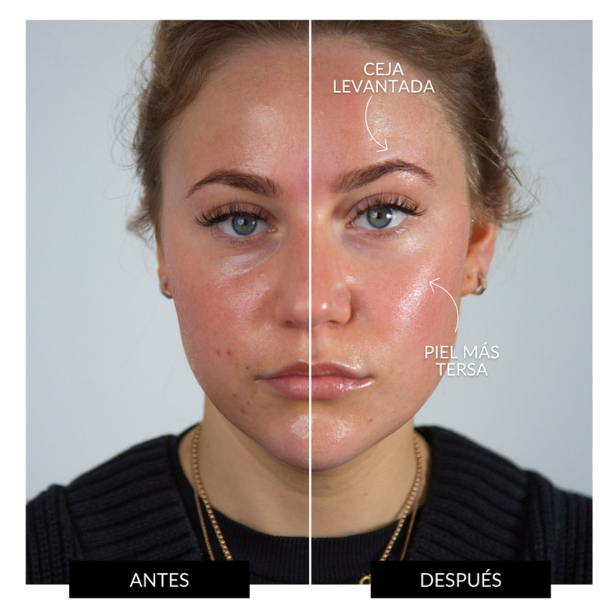 Rostro antes y después: piel irregular izquierda, más firme y ceja alzada derecha.