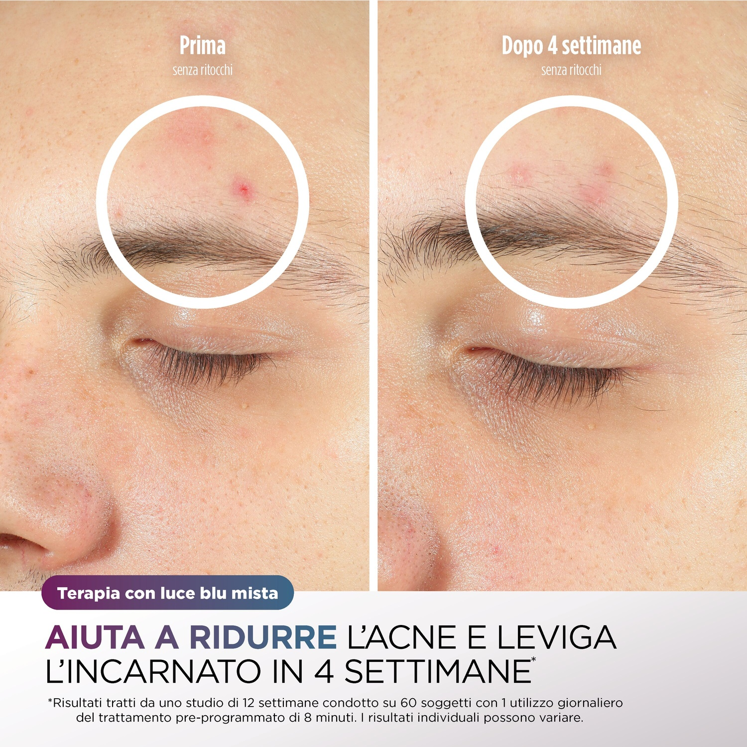 Confronto prima e dopo pelle acneica, con miglioramento in 4 settimane.