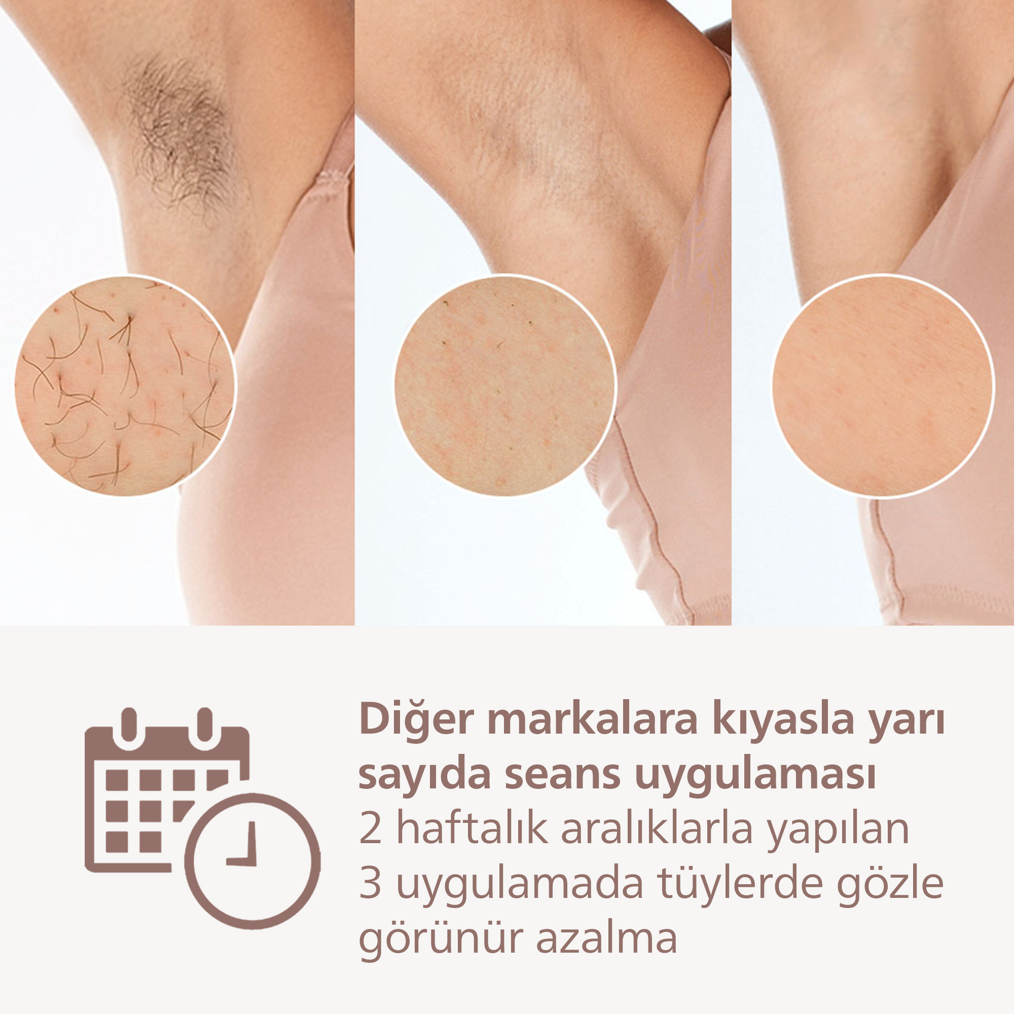 Koltuk altı tüylerinin öncesi-sonrası karşılaştırması, 3 seansta azalma.