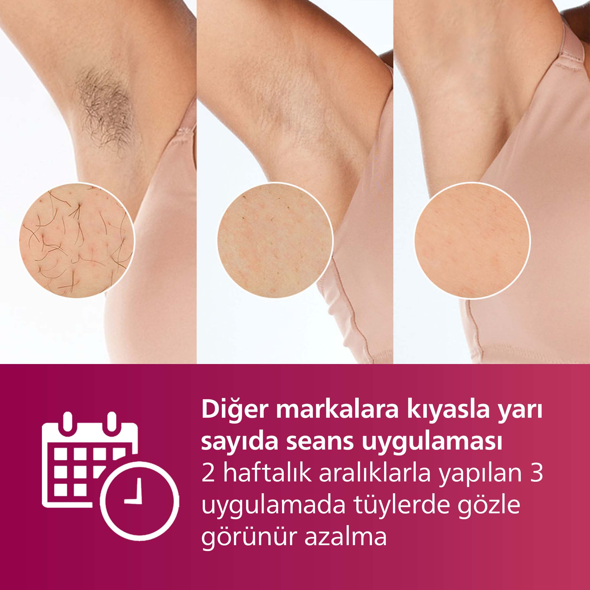 Karşılaştırma: Daha az seans, 2 haftada 3 uygulama ile gözle görülür tüy azalması.