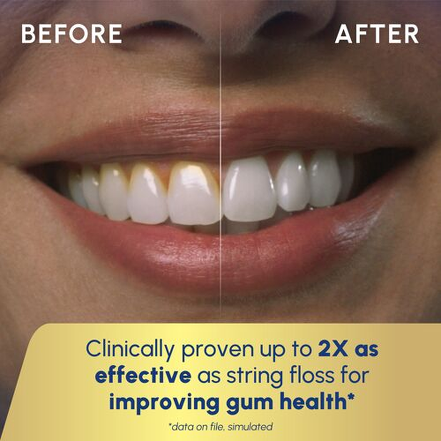 Before and after comparison of teeth changing from yellow to white.