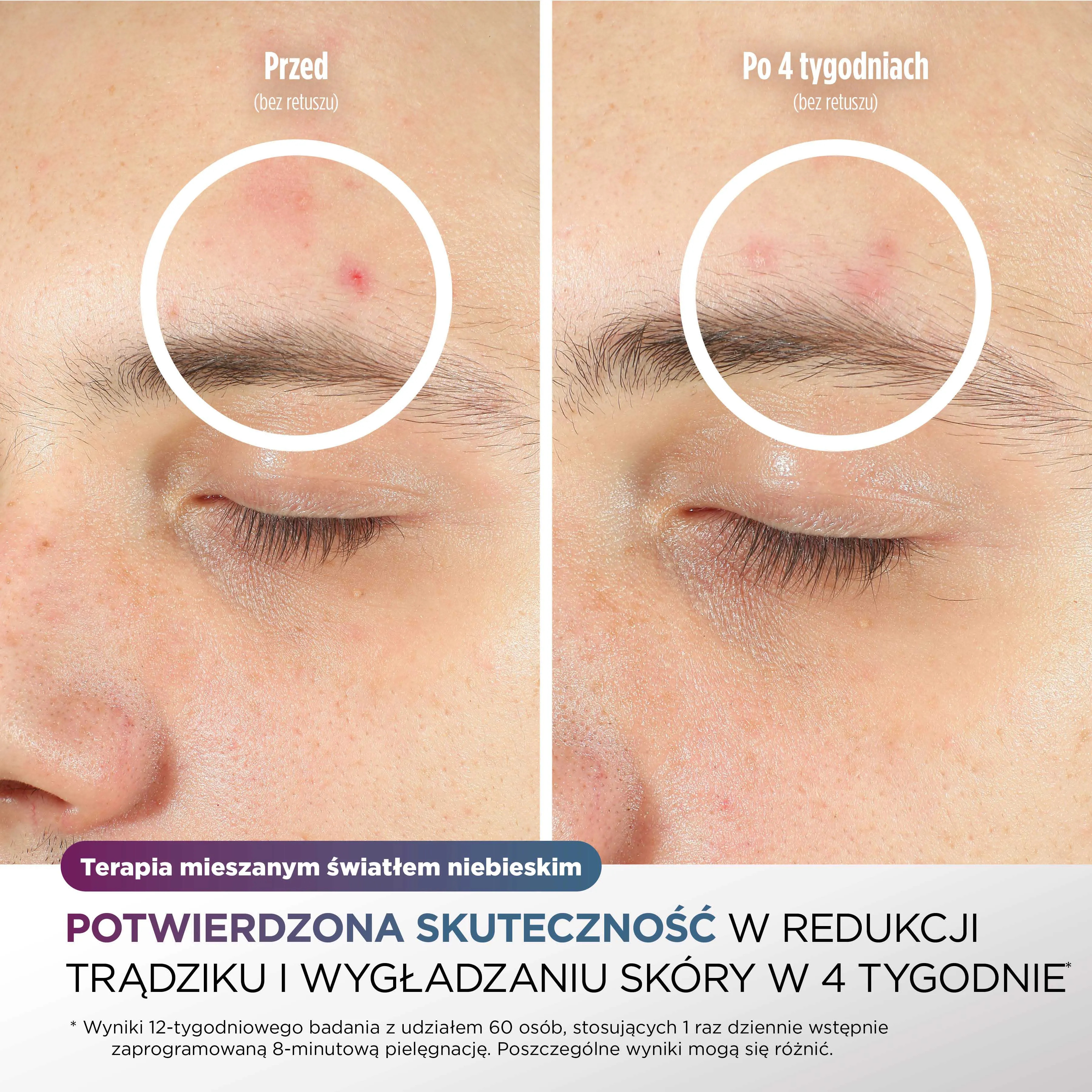 Porównanie skóry trądzikowej przed i po 4 tygodniach leczenia.