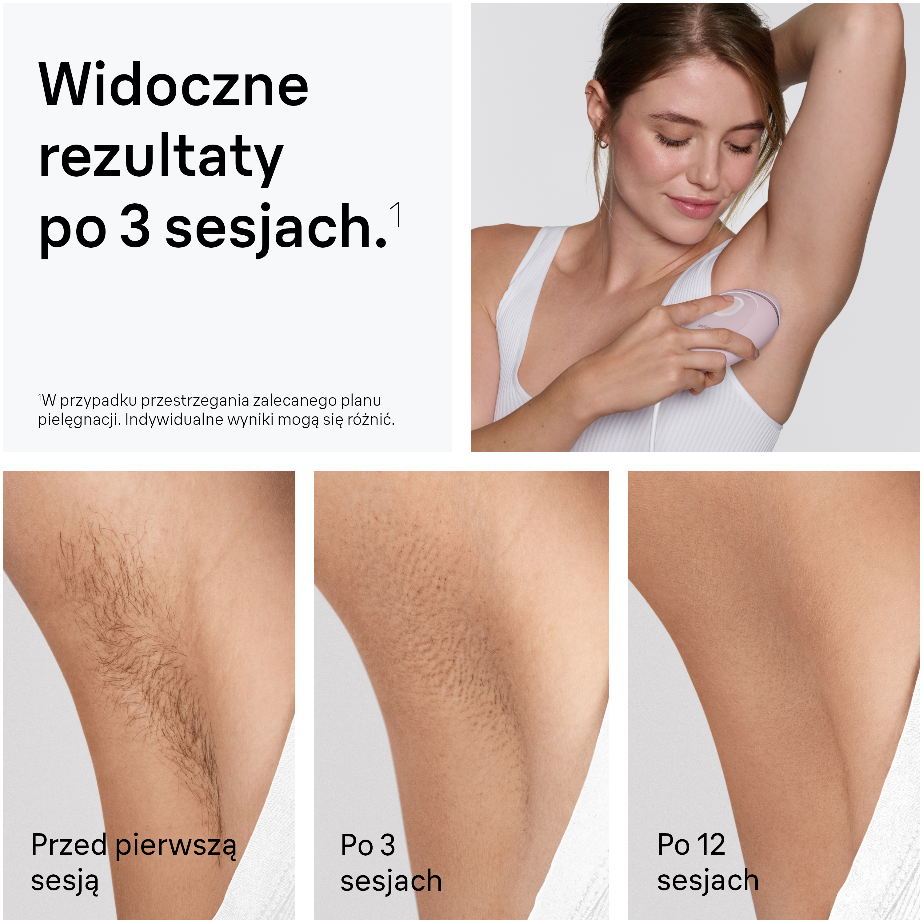 Kobieta używa depilatora. Wyniki przed, po 3 i 12 sesjach.