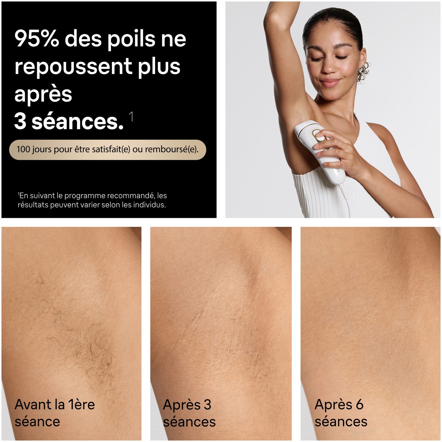 Femme utilisant un appareil IPL. Photos avant/après poils sous les bras après 1, 3 et 6 séances.