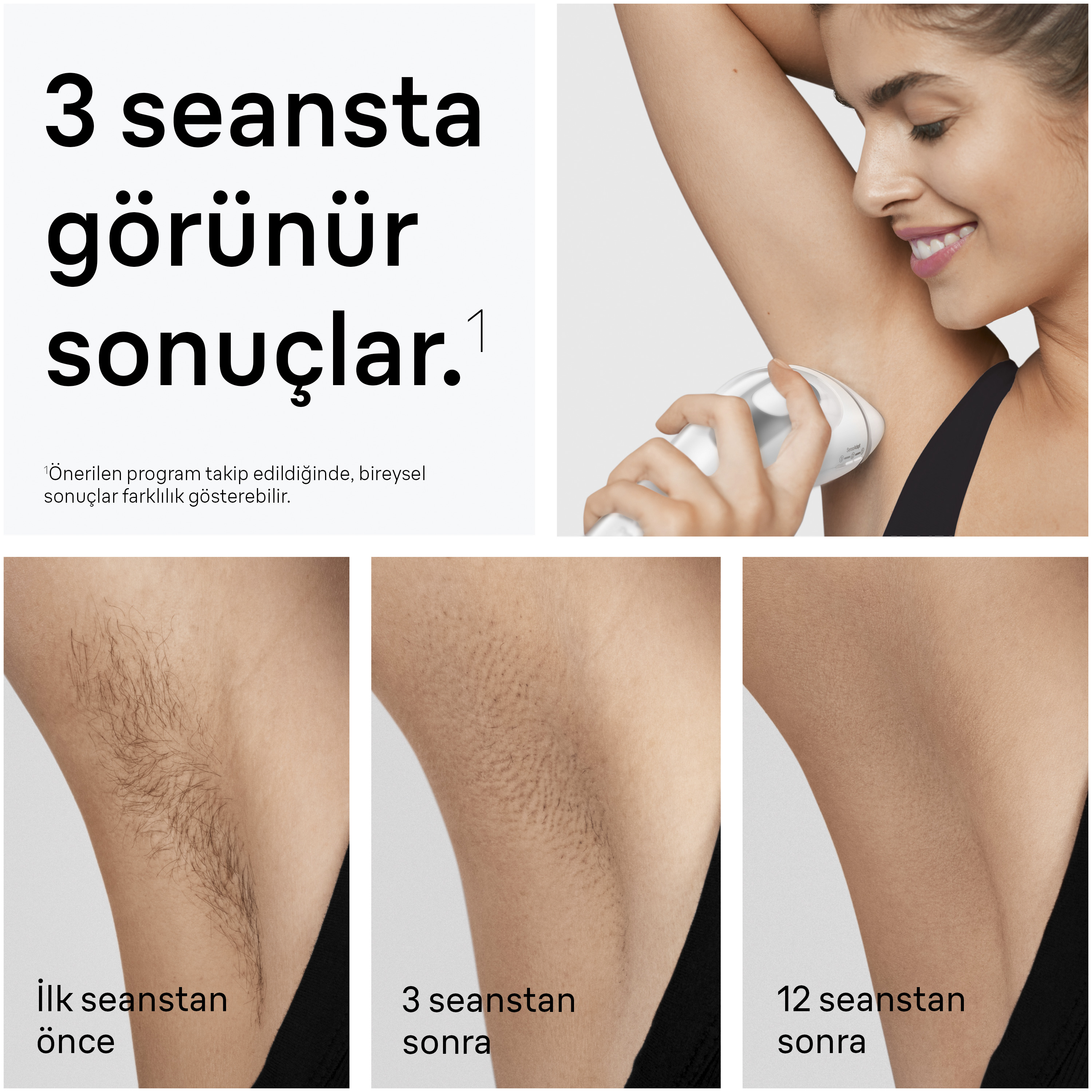 Koltuk altı kılları ilk, 3 ve 12 seans sonrası. Tüylü cilt, sonra azalmış.