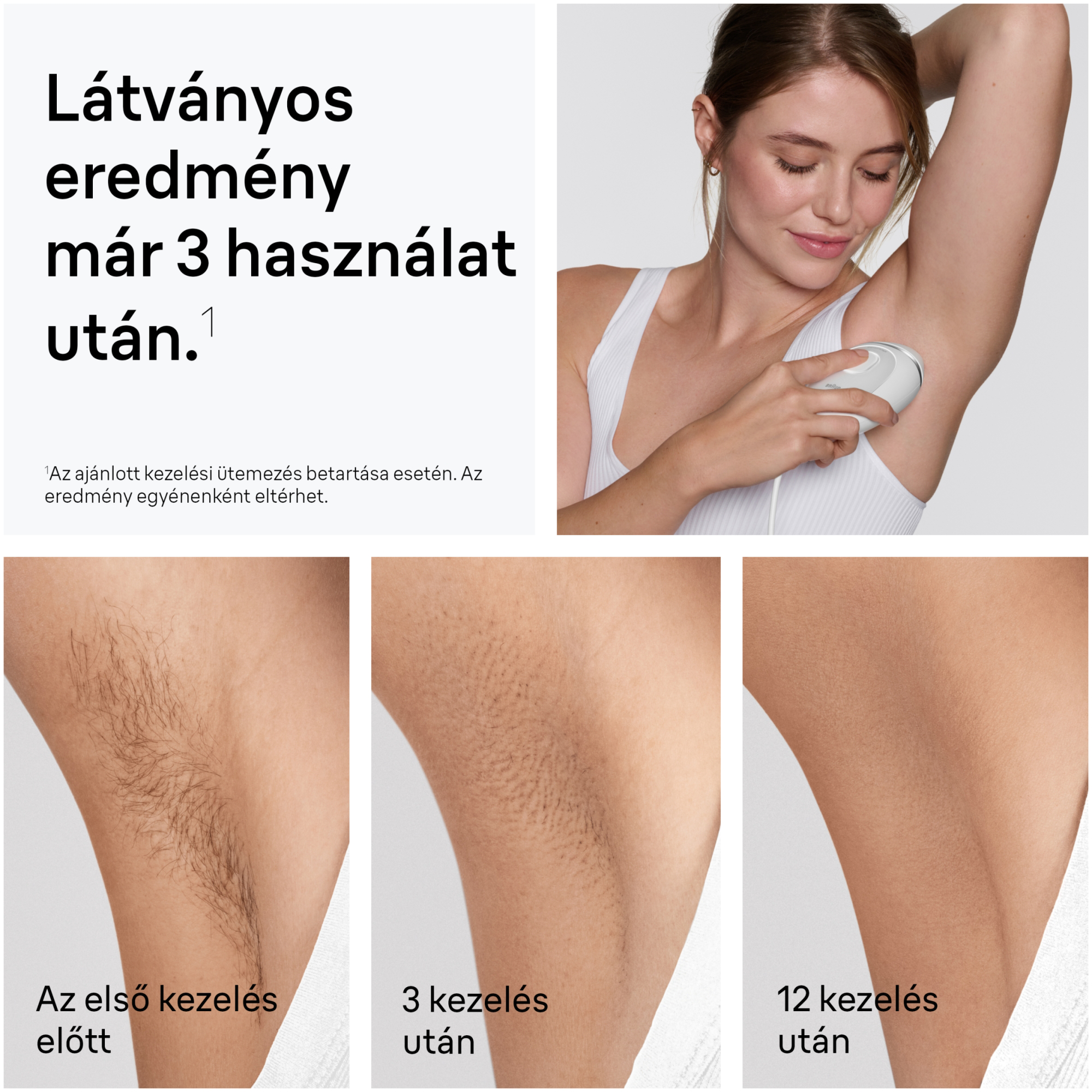 Nő hónalj epilálása. Hónaljszőrzet előtte/utána összehasonlítás.