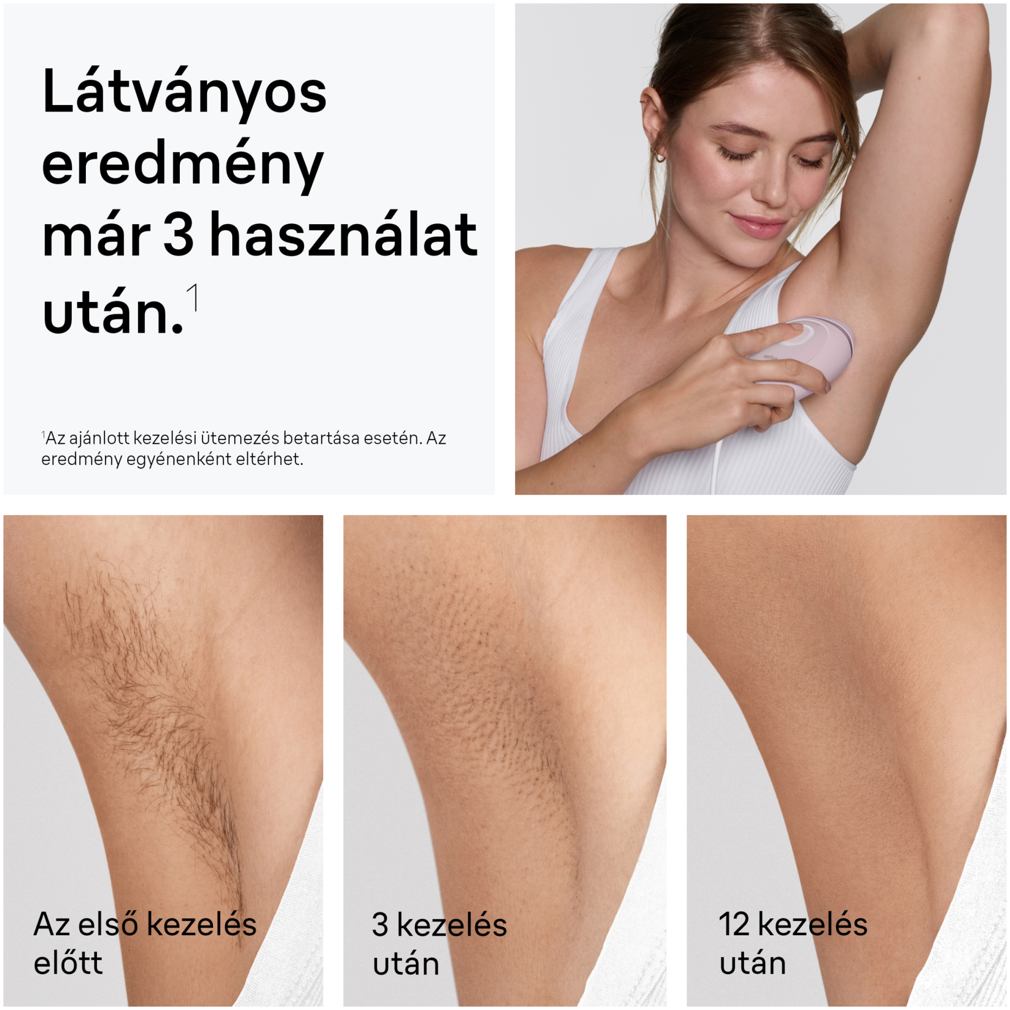 Előtte-utána képek a hónaljszőr csökkenéséről 1, 3 és 12 kezelés után.