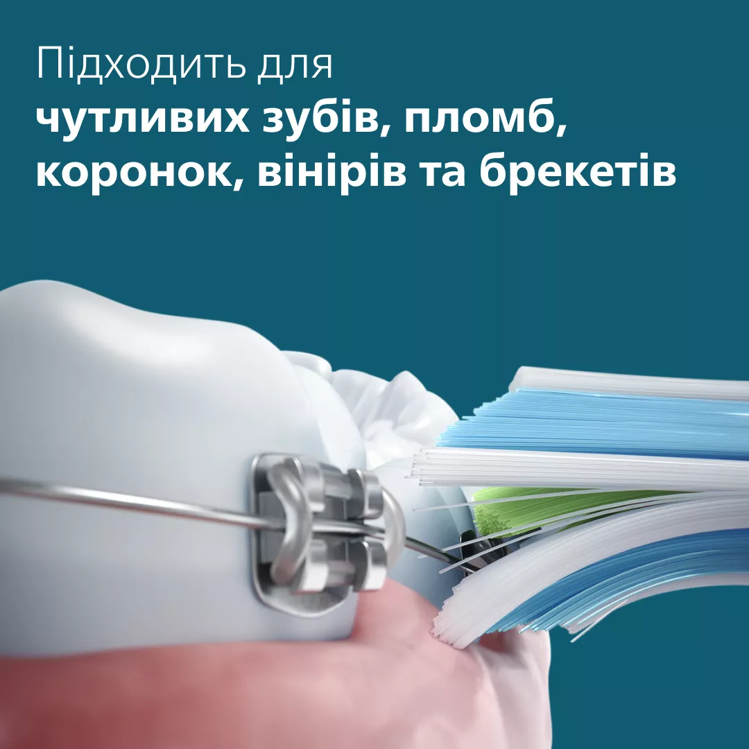 Zbliżenie aparatu ortodontycznego na zębie, obok szczoteczki do zębów z niebieskim włosiem.