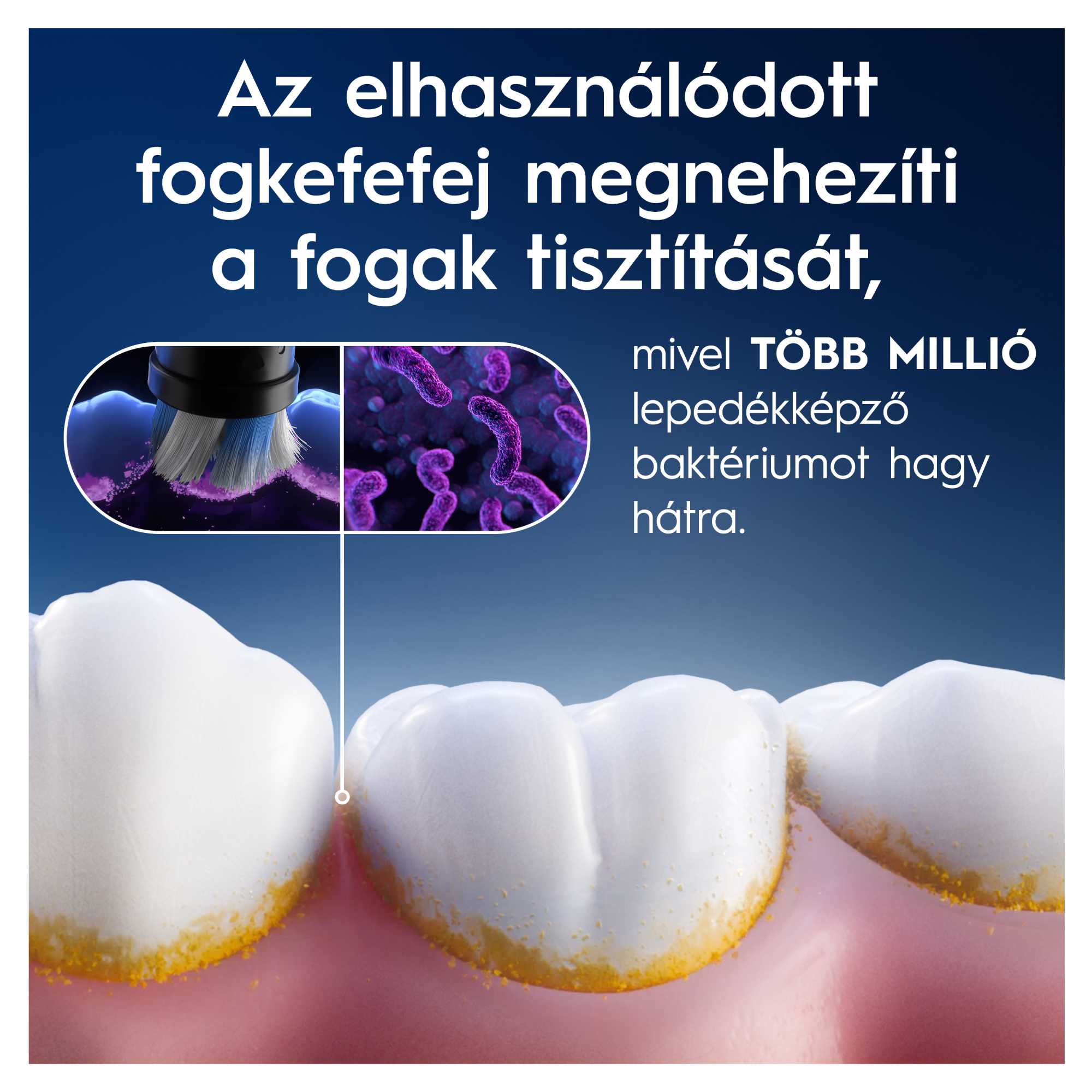 Az elhasználódott fogkefe megnehezíti a tisztítást, baktériumokat hagyva hátra.