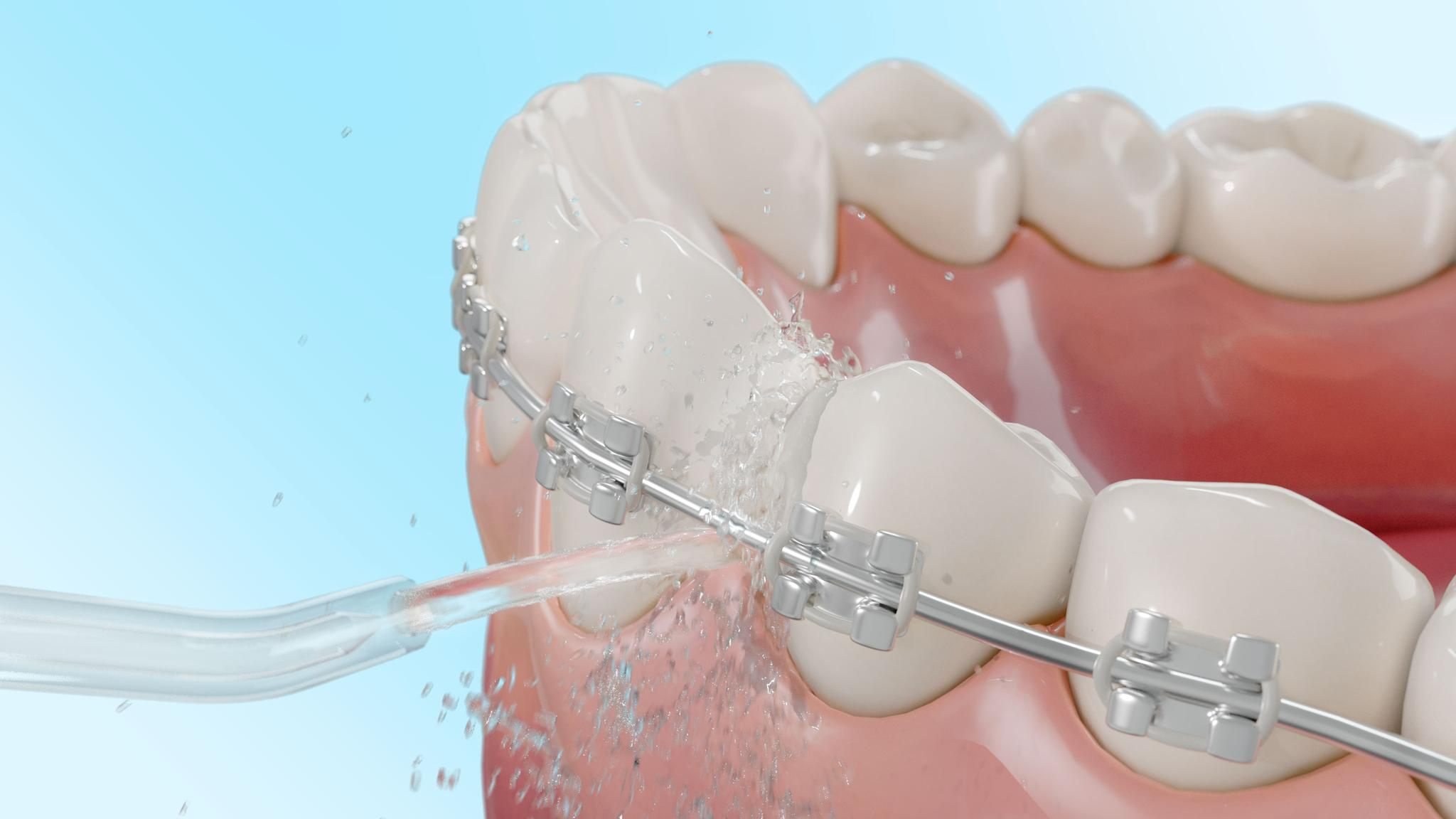 Un irrigador bucal limpia dientes con brackets, rociando chorros de agua alrededor.