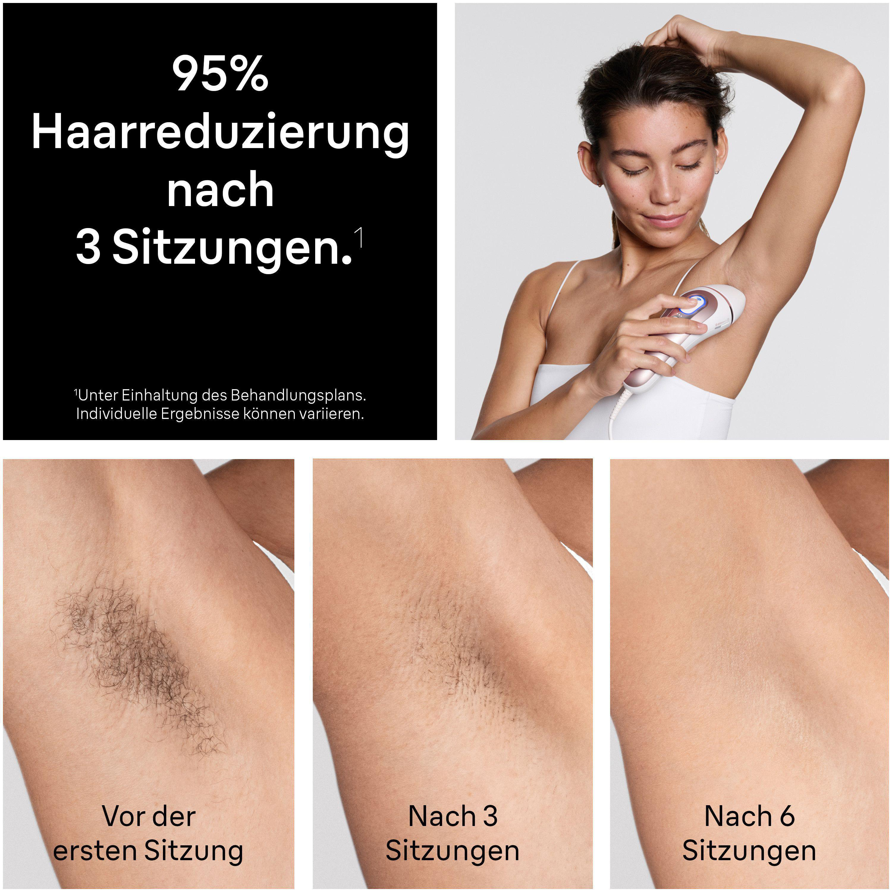 Eine Frau nutzt ein IPL-Gerät an der Achsel; drei Nahaufnahmen zeigen Haare vorher, nach 3 und 6 Sitzungen.