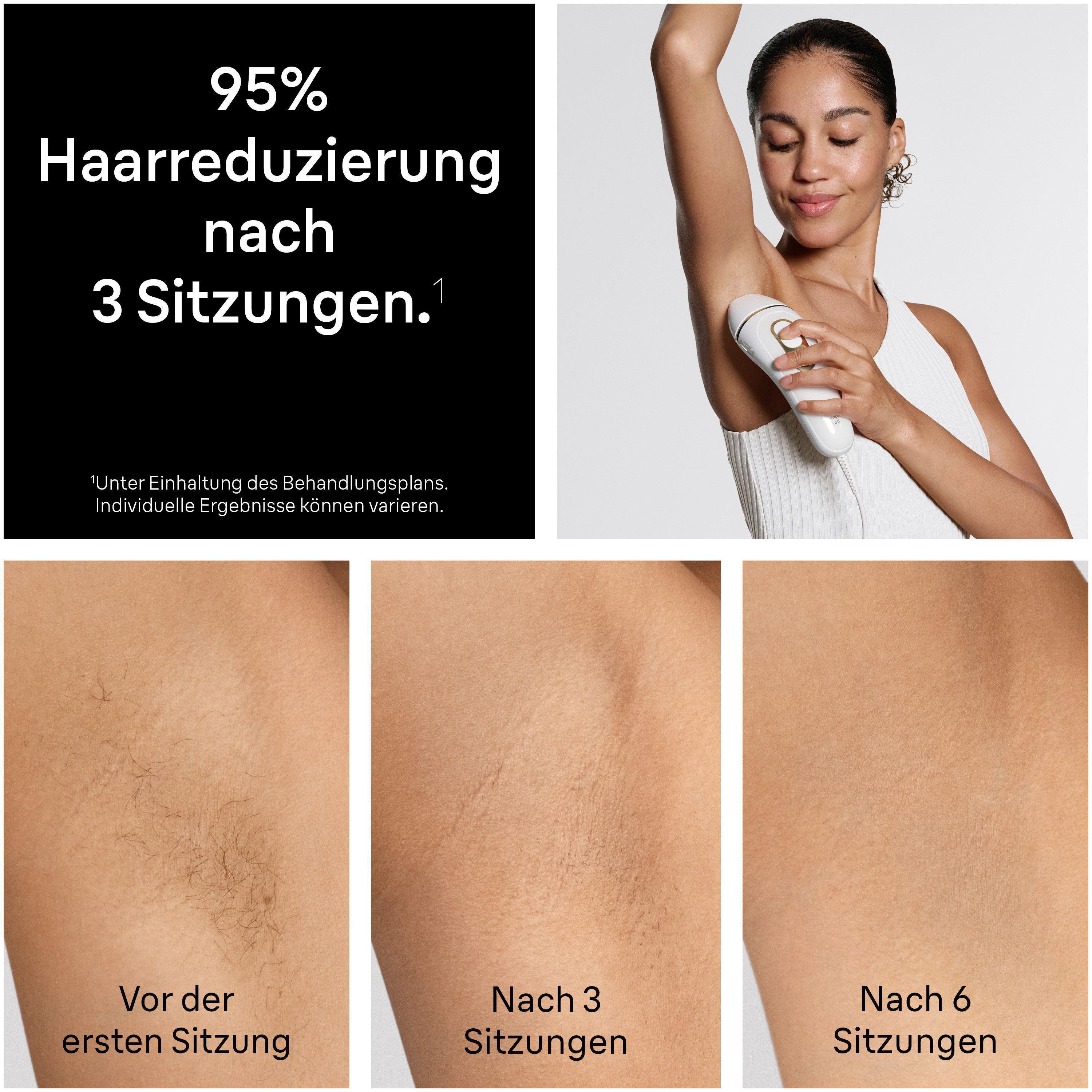Eine Frau nutzt ein IPL-Haarentfernungsgerät an der Achsel, mit Hautergebnissen vor und nach den Sitzungen.