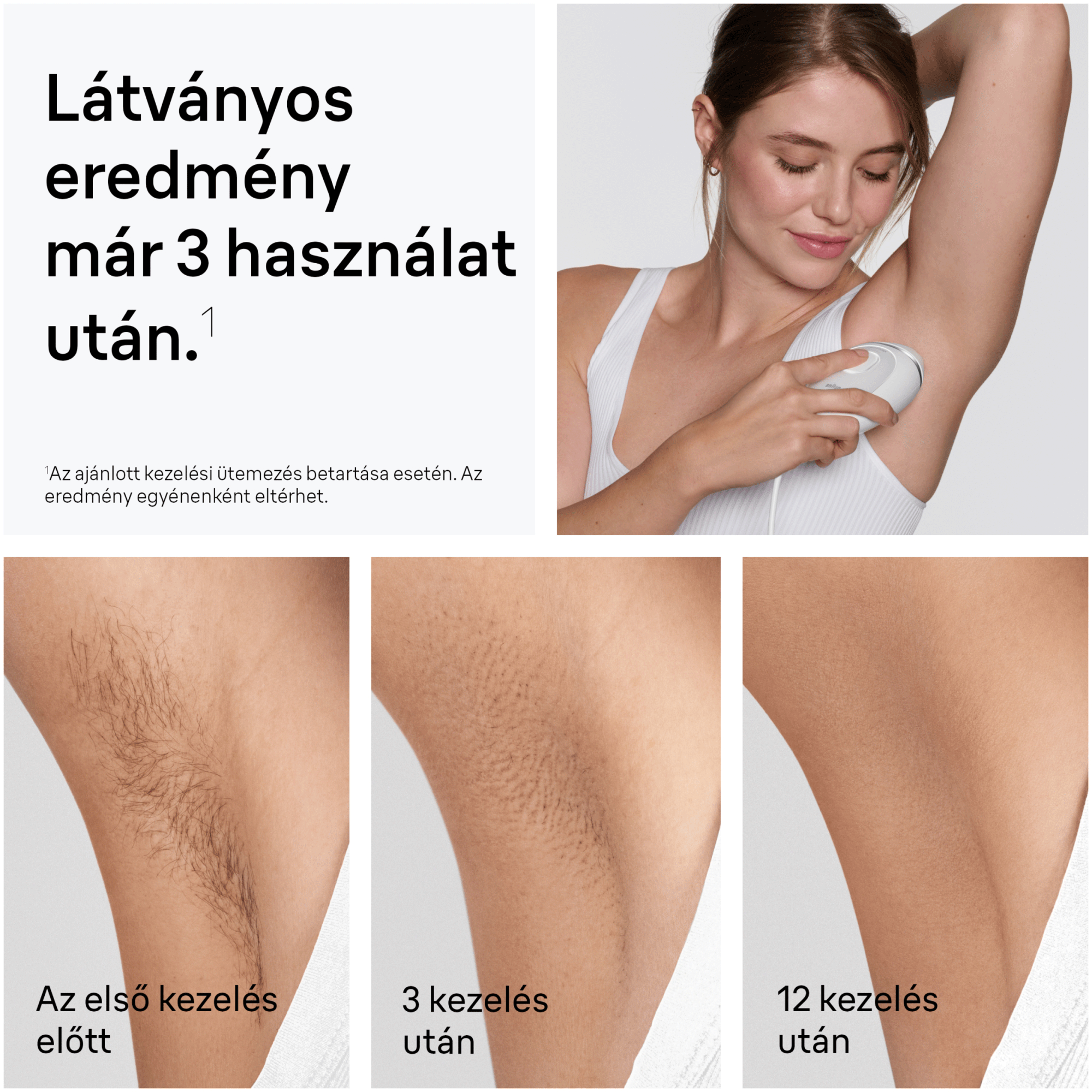 Egy nő IPL szőrtelenítő készüléket használ a hónalján, a kezelések előtti és utáni állapotot mutatva.